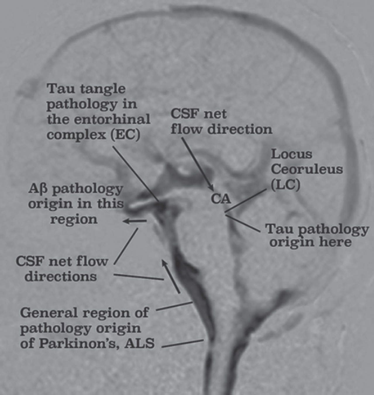 Origins of Aβ and tau AD pathology correlates with black areas in this figure revealing regions in which CSF motion is found to be chaotic. Parkinson’s disease and amyotrophic lateral sclerosis (ALS) pathology also originate in the lower brainstem region where motor nerves and arteries jut into chaotic CSF. From [3] with modifications. Licensed and modified under a Creative Commons Attribution Non-Commercial-No Derivatives International.