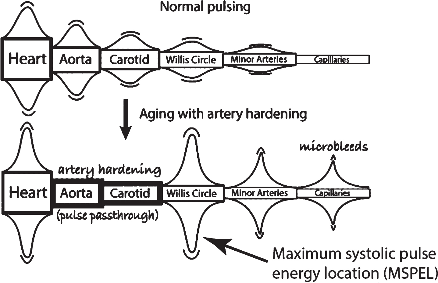 Steady migration of Maximum Systolic Pulse Energy Location (MSPEL) for blood and CSF with age through the brain extending further from the heart with artery hardening. A similar diagram exists with “Basilar” substituted for “Carotid.” With permission [5].