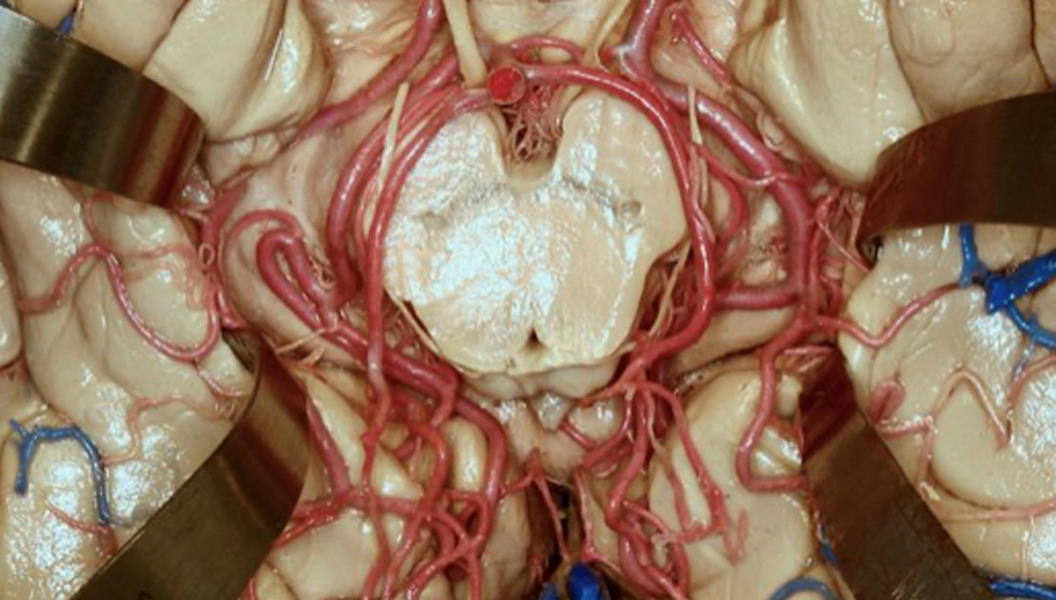 Vasculature surrounding the midbrain. Used by permission from the Neurosurgical Atlas by Aaron Cohen-Gadol, MD.