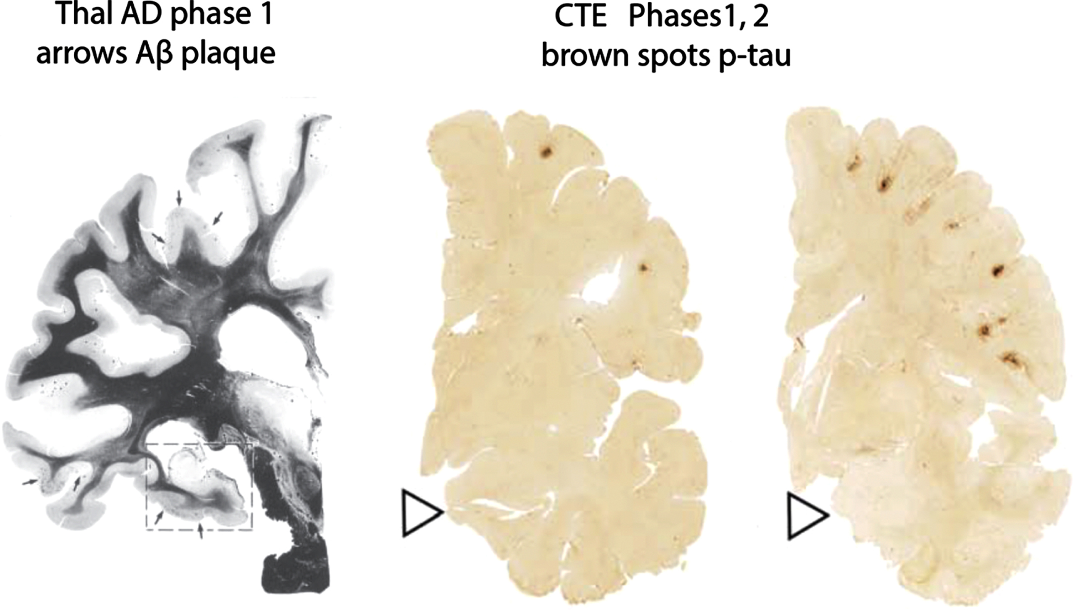 Earliest cortical pathological stages in AD (left) and CTE (right two images) phase 1 AD Aβ plaque pathology is noted by black arrows primarily in sulci. (There is no early cortical tau pathology in AD.) CTE tau pathology on the right is result of p-tau staining. (There is no CTE Aβ pathology other than that from coexisting CTE and AD). Sources: left [107] with permission; right two [91] with permission.