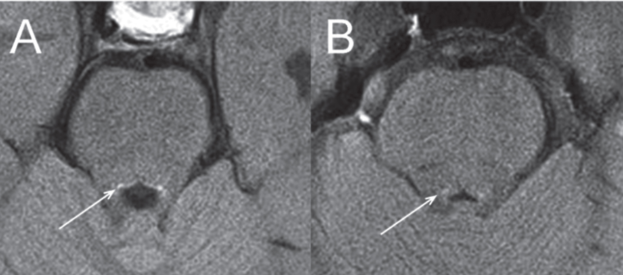Neuromelanin-sensitive MRI imaging of the locus coeruleus/subcoeruleus. Axial neuromelanin-sensitive T-weighted images of the locus in a healthy volunteer (A) and a patient with Parkinson’s disease (B). The locus area (arrows) is visible as an area of increased signal intensity. With permission from [105].