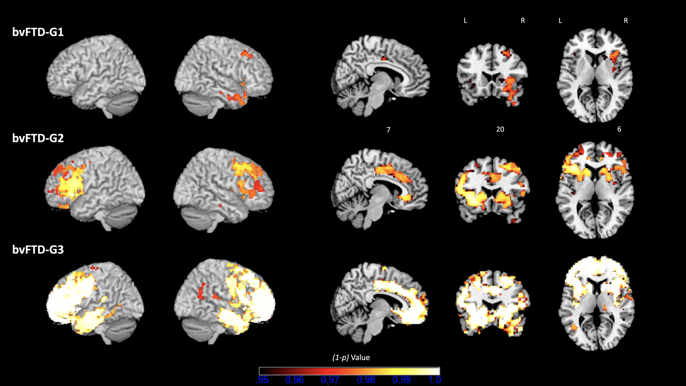 Three bvFTD subgroups and their VBM– derived GM atrophy maps. bvFTD-G1 (N = 8), bvFTD-G2 (N = 5), and bvFTD-G3 (N = 7). The (1-p) value maps show the atrophy patterns compared with HC (N = 16) and are superimposed onto a whole-brain MNI template. Effects were corrected for age and sex, and statistical significance was set at p < 0.05 FWE-corrected for multiple comparisons.