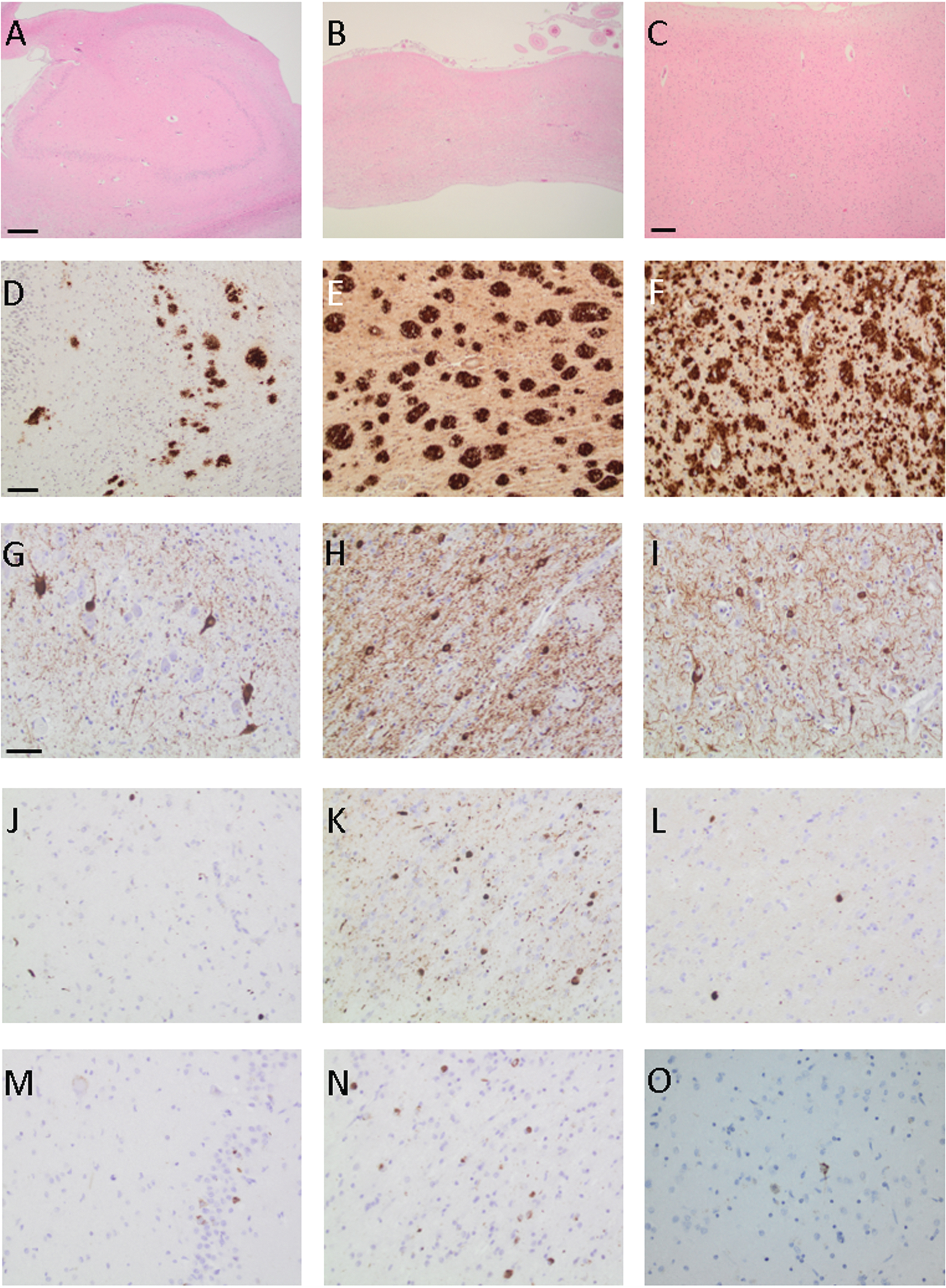 Photomicrographs of brain samples from a PSEN1 G206R mutation carrier from the hippocampus (A, D, G, J, and M), remnants of amygdala (B, E, H, K, and N) and neocortex (C, F, I, L and O) when applying hematoxylin-eosin staining (A–C) and antibodies towards total amyloid β (D–F), hyperphosphorylated τ (G–I), α-synuclein (J–L), and transactive DNA binding protein 43 (M–O). Bar in A-B 500μm, C 200μm, D–F 100μm, and G–O 50μm.