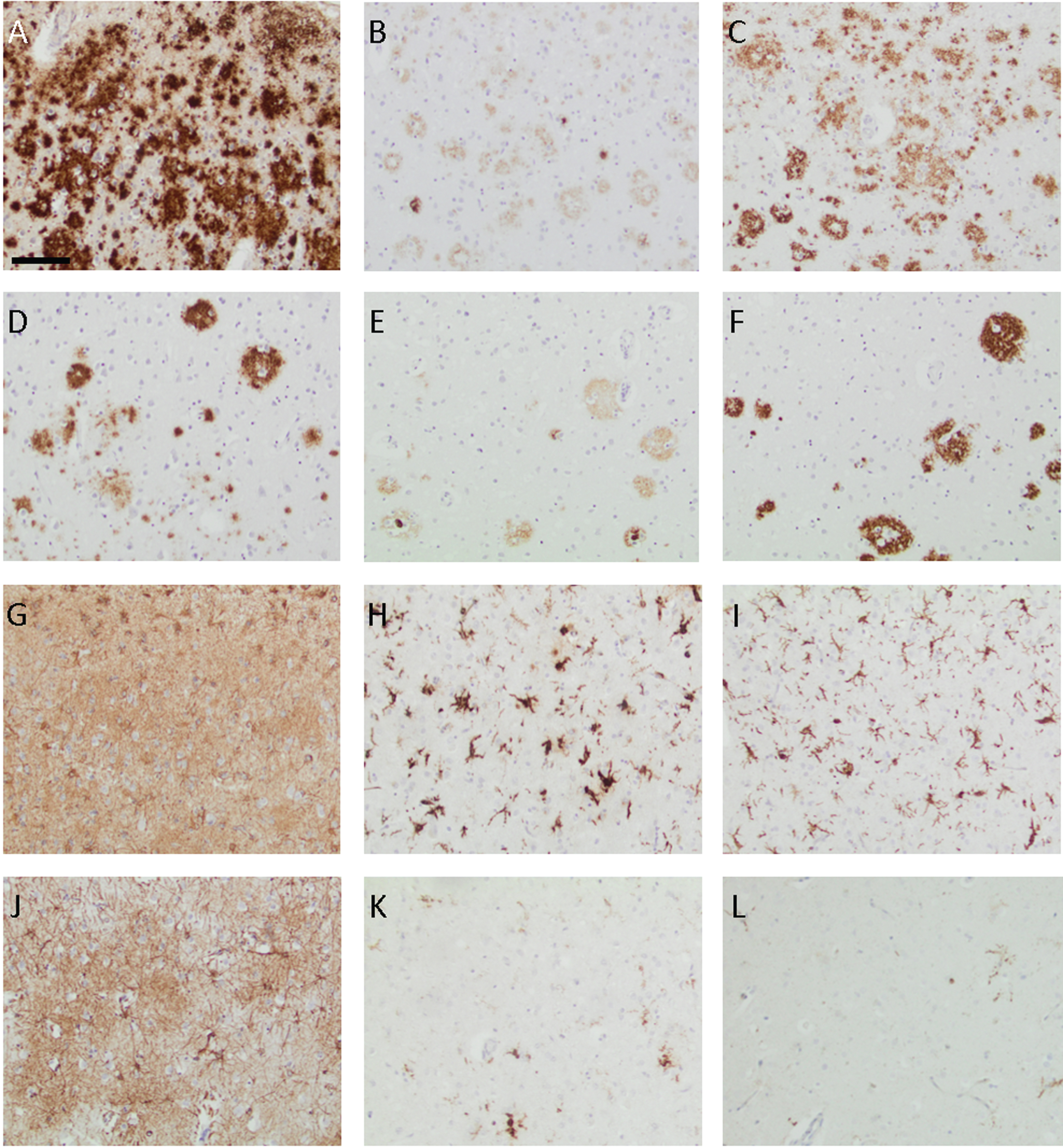 Photomicrographs of the neocortex from the PSEN1 G206R mutation carrier (A–C and G–I) and the subject with sporadic Alzheimer’s disease (D–F and J–L) when applying antibodies to the total amyloid-β (Aβ) (A and D), Aβ40 (B and E), Aβ42 (C and F), glial fibrillary acidic protein (G and J), human leucocytic antigen-DR (H and K), and ionized calcium-binding adaptor molecule 1 (I–L). Bar in A-L 100μm.