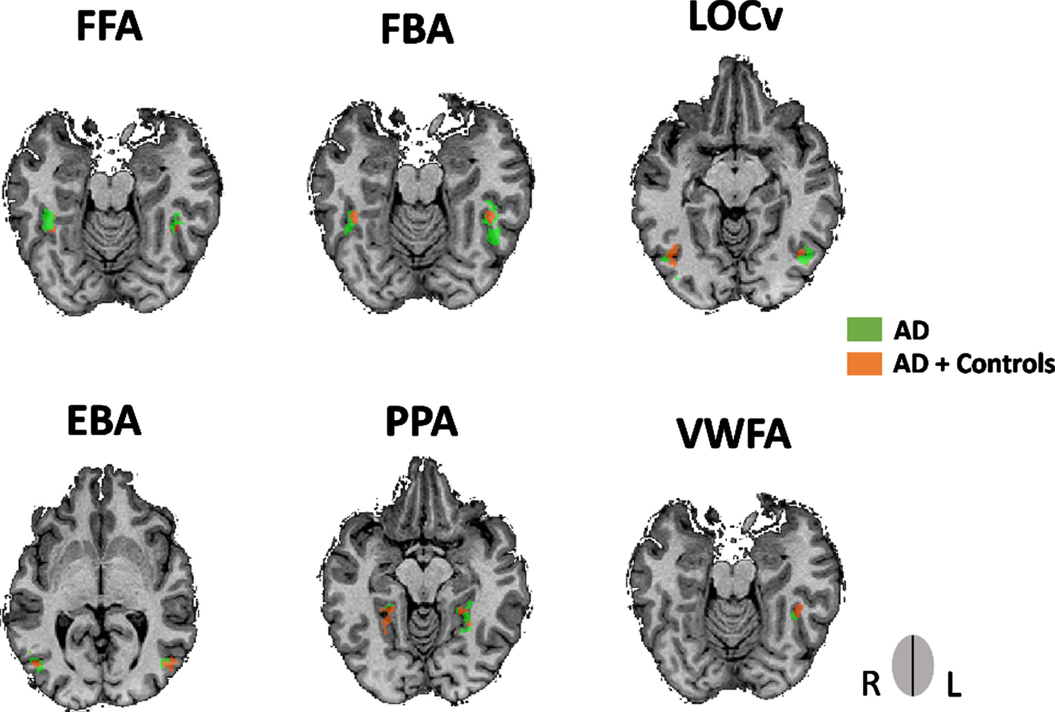 ROIs obtained from the multisubject GLM for the AD group showing an overlap with the ROIs obtained from both groups (AD and controls). The former ROIs was only performed as a control measure. Legend: rFFA, AD’s PV = 39, -40, -17; lFFA, AD’s PV = -42, -43, -20; rFBA, AD’s PV = 39, -43, -17; lFBA, AD’s PV = -45, -43, -14; rEBA, AD’s PV = 45, -73, 1; rEBA, AD’s PV = -48, -67, 7; rLOCv, AD’s PV = 45, -71, -8; lLOCv, AD’s PV = -42, -67, -8; rPPA, AD’s PV = 24, -40, -8; lPPA, AD’s PV = -27, -46, -11; lVWFA, AD’s PV = -39, -46, -17.