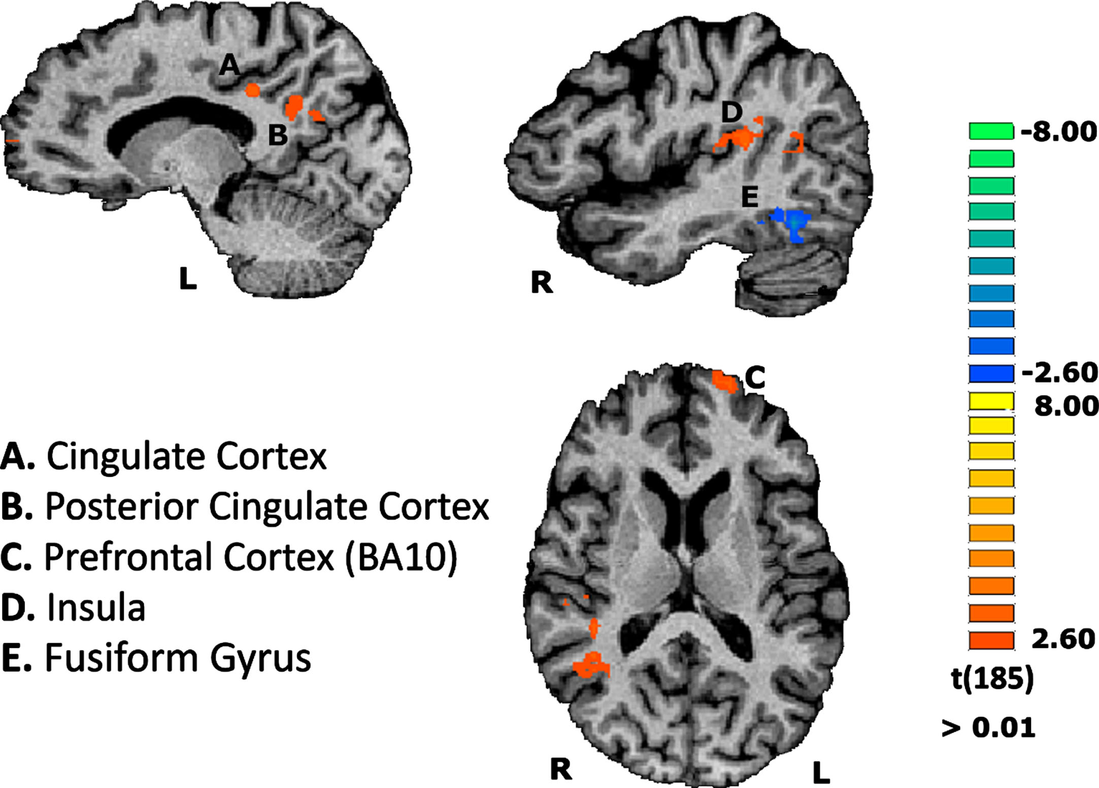 Group differences concerning the contrast of scrambled stimuli vs baseline, on the functional task. Results are depicted showing regions differentially activated in AD compared to controls. Region A: CM = -15, -37, 34; PV = -13, -35, 33; Nr. Voxels = 330 / Region B: CM = -11, -56, 26; PV = -10, -56, 30; Nr. Voxels = 649 / Region C: CM = -18, 63, 11; PV = -19, 64, 12; Nr. Voxels = 329 / Region D: CM = 42, -32, 18; PV = 47, -23, 18; Nr. Voxels = 989.