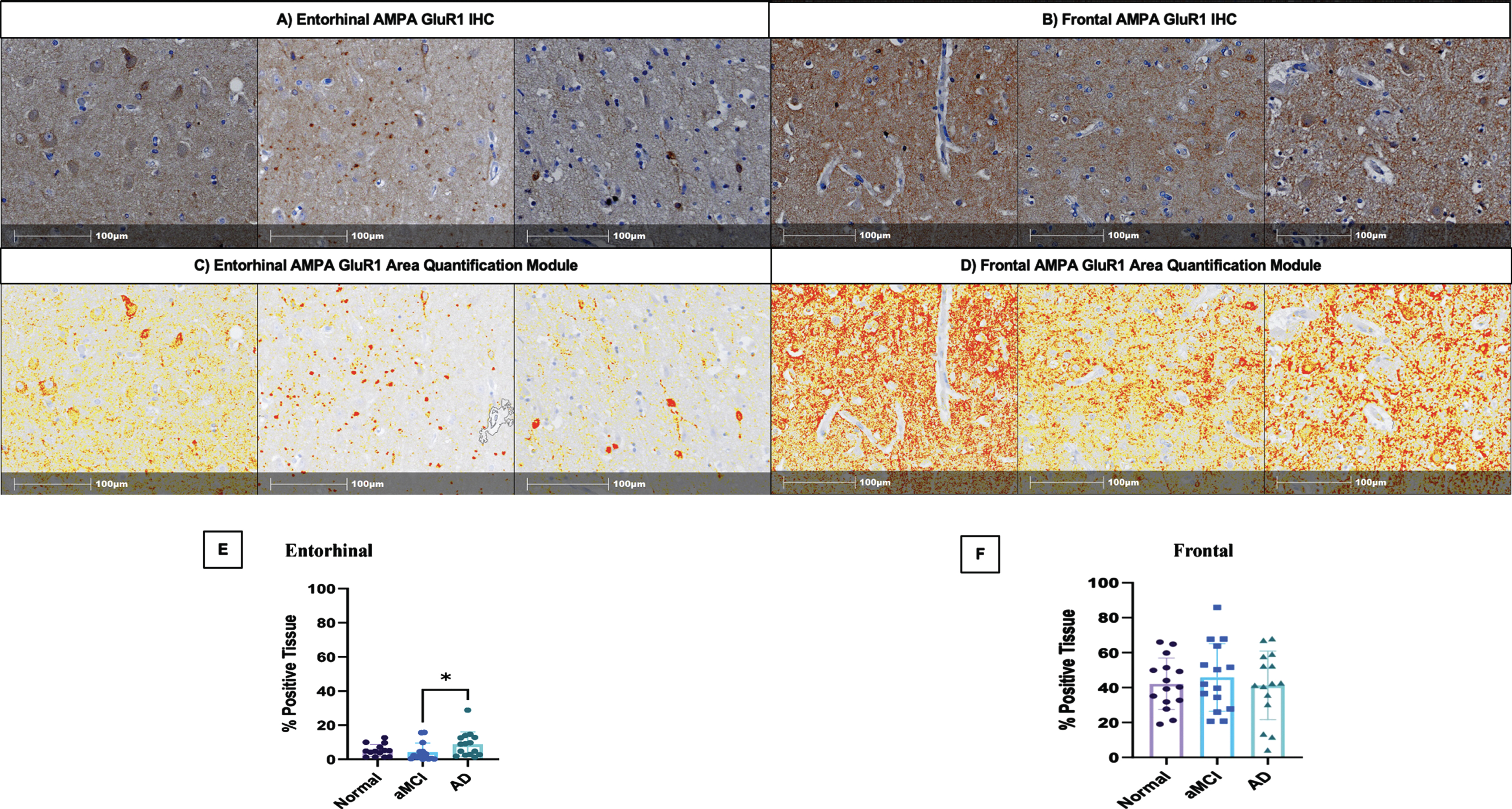 Area Quantification analysis of AMPA GluR1 receptor expression in the entorhinal cortex, and middle frontal cortex. A) AMPA GluR1 immunohistochemical staining in the entorhinal cortex of normal control, aMCI, and AD dementia cases, respectively. B) AMPA GluR1 immunohistochemical staining in the frontal cortex of normal control, aMCI, and AD dementia cases, respectively. C) Indica Labs Halo Area Quantification analysis of AMPA GluR1 immunohistochemical staining in the entorhinal cortex of normal control, aMCI, and AD dementia cases, respectively. D) Indica Labs Halo Area Quantification analysis of AMPA GluR1 immunohistochemical staining in the frontal cortex of normal control, aMCI, and AD dementia cases, respectively. E) % Positive area of AMPA GluR1 staining in entorhinal cortex stratified by clinical group designations (normal, aMCI, AD). p = 0.03. F) % Positive area of AMPA GluR1 staining in the frontal cortex stratified by clinical group designations (normal, aMCI, AD). aMCI, amnestic mild cognitive impairment; AD, Alzheimer’s disease dementia.