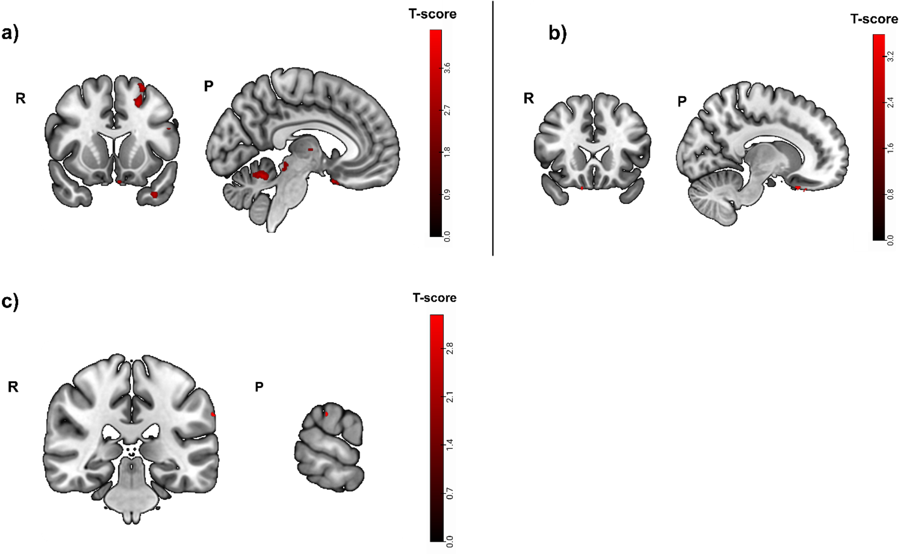 Greater activity related to greater hippocampal atrophy in the spatial abilities task ([translation+rotation]>luminance conditions contrast, puncorrected < 0.01), used as mask. Activity was detected in the left subcallosal area, the cerebellar vermal lobules I-V and the left cerebral white matter/superior frontal gyrus. b) Greater activity related to high spatial abilities task accuracy (before masking) was located in the right medial orbital gyrus and the left supramarginal gyrus (puncorrected < 0.001). c) After inclusive masking a significant effect in the left supramarginal gyrus was detected (puncorrected < 0.001). R, right; P, posterior.