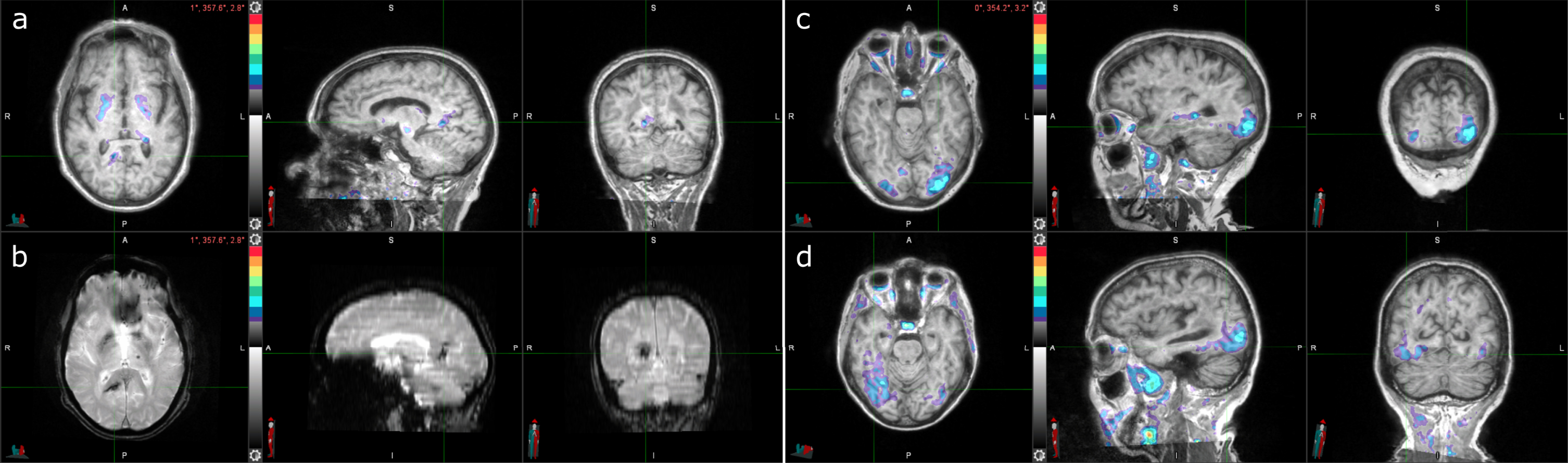 Three cases with tau-positive visual interpretations, but tau-negative SUVRs. a) Tau PET coregistered with MRI of a male participant in his 80s with elevated right precuneus uptake. b) Corresponding T2*-weighted MRI showing a hypointensity (indicated by the crosshair) that colocalizes with the elevated right precuneus uptake from (a). c) Tau PET coregistered with MRI of a female participant in her 70s with elevated occipital lobe uptake, left greater than right. d) Tau PET coregistered with MRI of a female participant in her 70s with elevated posterolateral temporal, occipital, and parietal/precuneus lobe uptake, right greater than left.