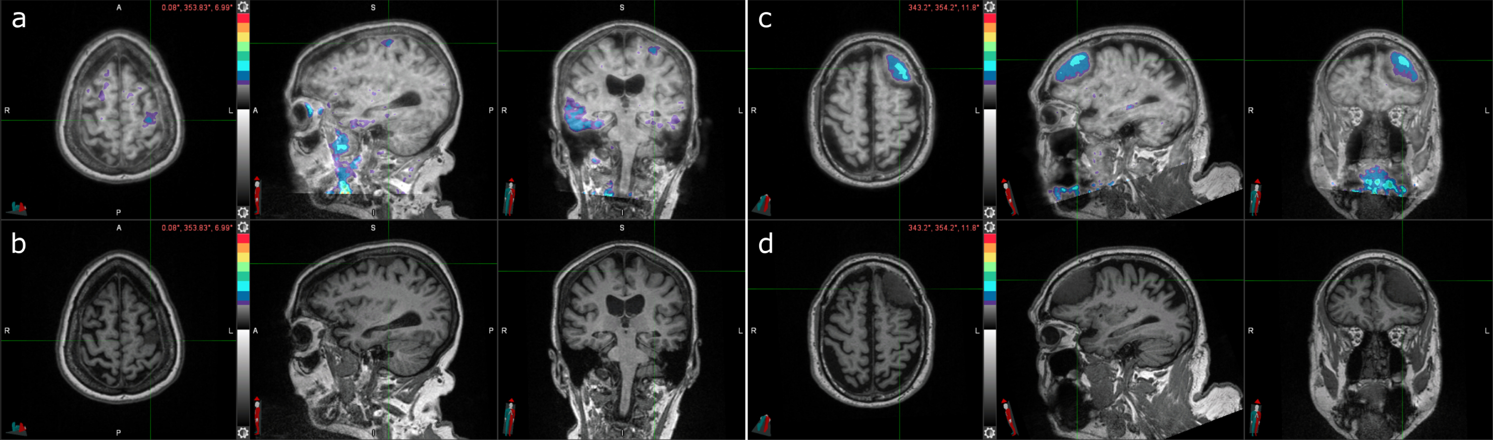 Two cases of incidental meningioma with tau PET uptake. a) Tau PET coregistered with MRI of a female participant in her 70s with a left frontal posterior meningioma (indicated by the crosshair) with tau radiotracer uptake. b) Corresponding MRI image. c) Tau PET coregistered with MRI of a male participant in his 70s with a left frontal meningioma (indicated by the crosshair) with tau radiotracer uptake. d) Corresponding MRI image.