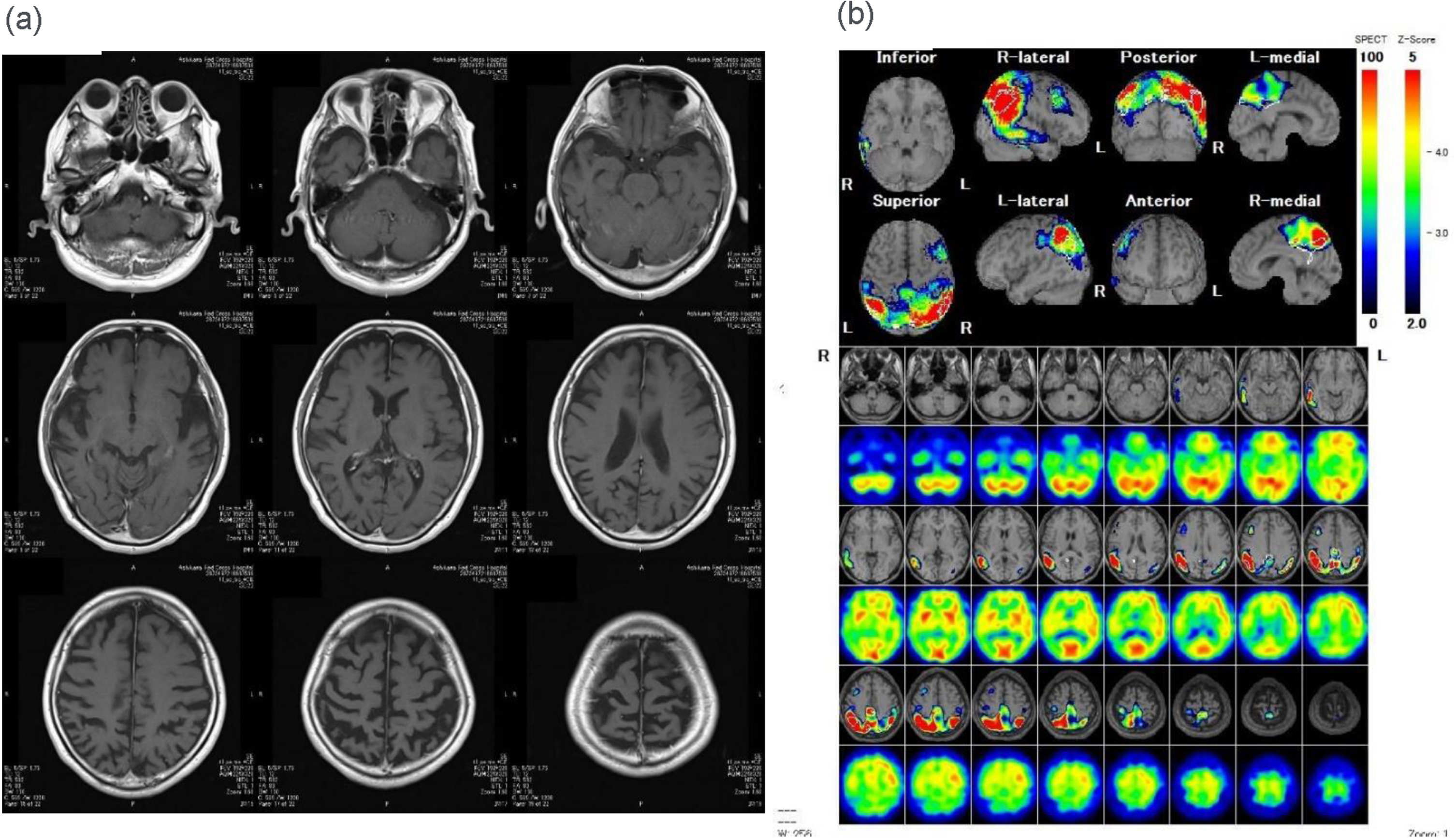 Brain images at 62 years. (a) Fluid-attenuated inversion recovery (FLAIR) magnetic resonance imaging of the individual’s head shows diffuse atrophy with a predominance in the right parietal lobe. (b) Brain 99mTc-ethyl cysteinate dimer (99mTc-ECD) single-photon emission computed tomography (SPECT) imaging of the head and the eZIS analysis shows relative hypoperfusion in the right parietal lobe.