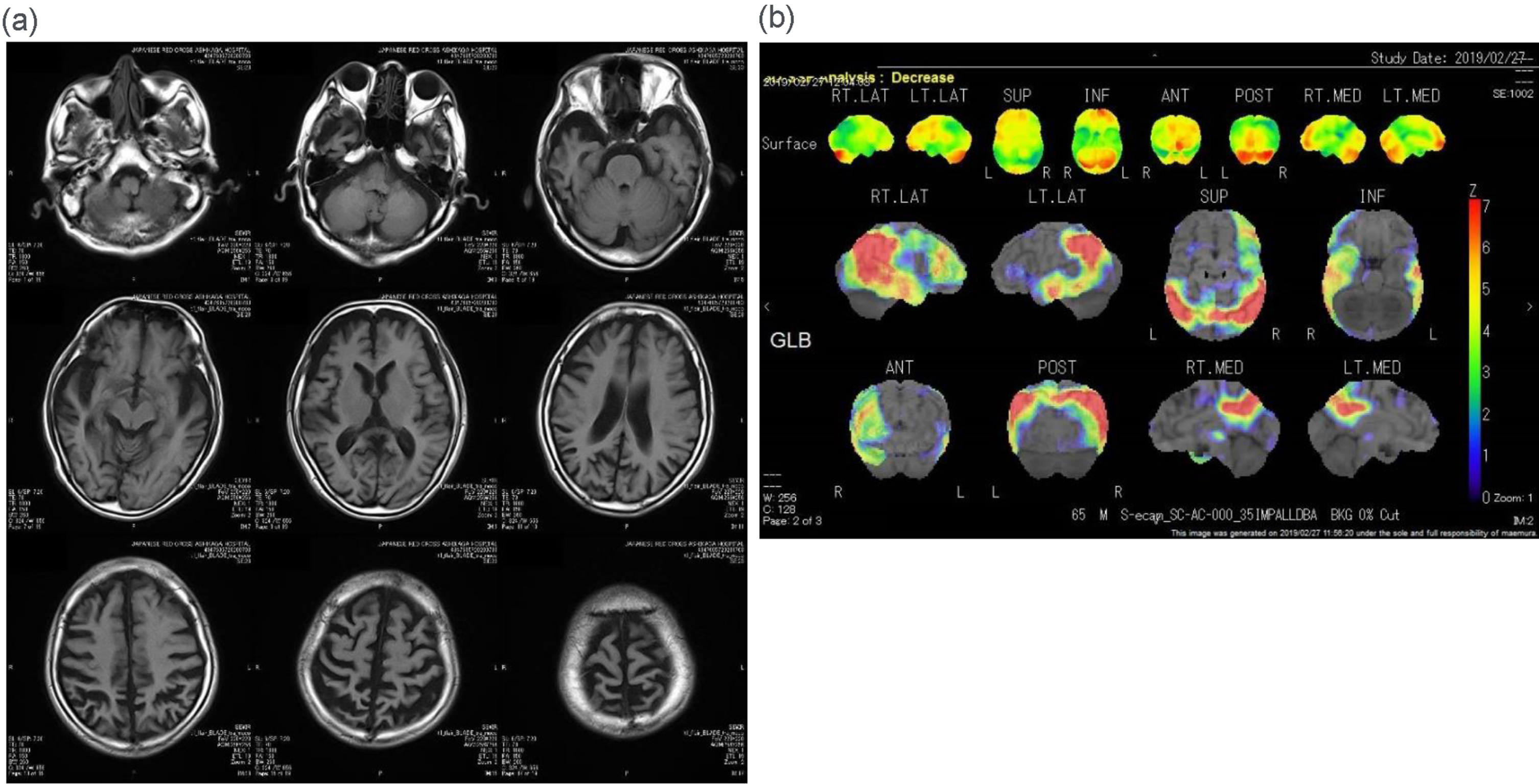 Follow-up brain images. (a) Fluid-attenuated inversion recovery (FLAIR) magnetic resonance imaging of the head of the patient at 66 years of age shows progressive atrophy of the right lateral temporal and parietal lobes as well as the left parietal lobe. (b) 123I-labeled N-isopropyl-p-iodo-amphetamine (123I-IMP) single-photon emission computed tomography (SPECT) imaging of the head of the same individual at 65 years of age and subsequent three-dimensional stereotactic surface projections (3D-SSP) analysis show that the relative hypoperfusion of both parietal lobes has progressed.