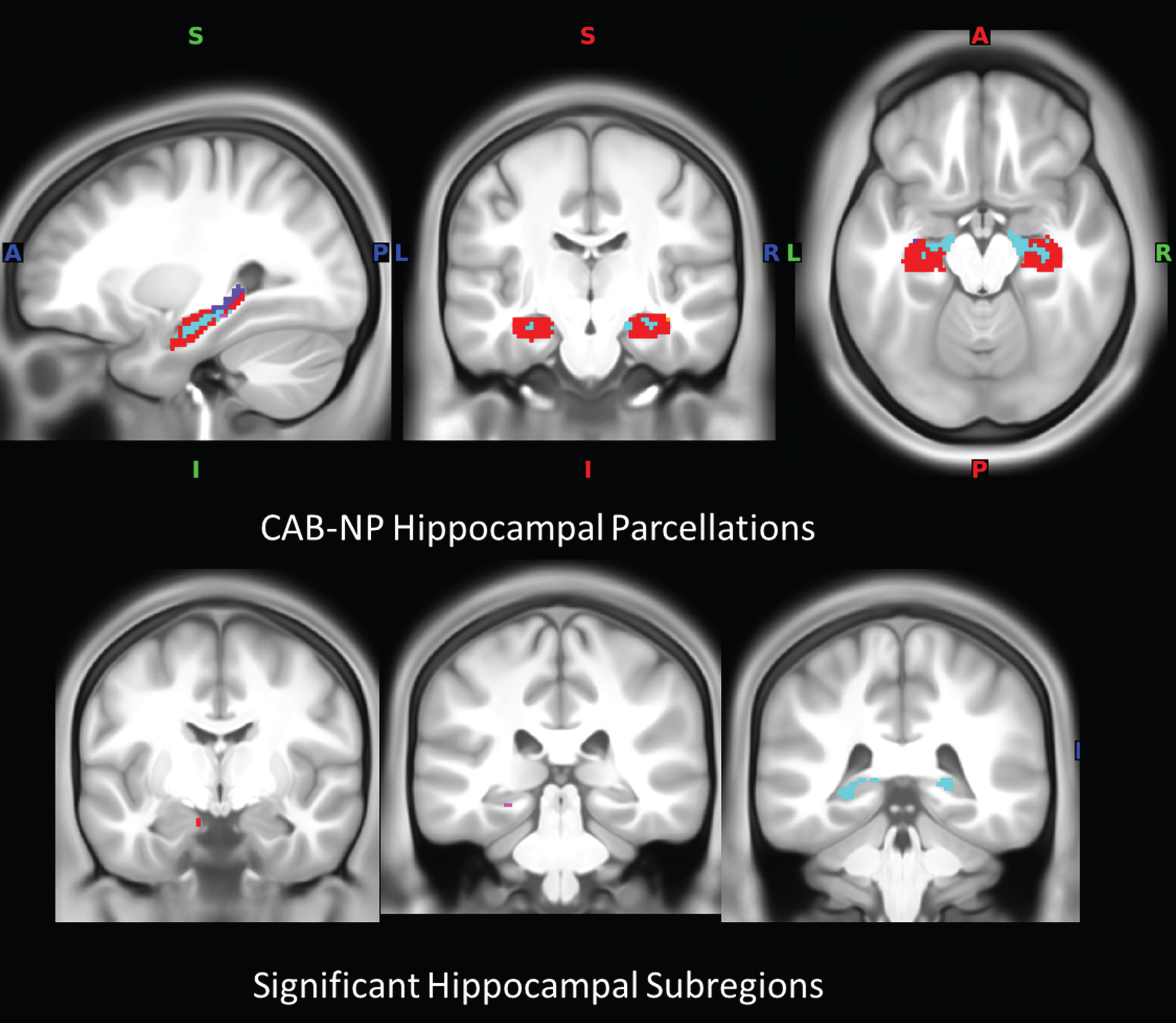 Hippocampal subregions. a) Hippocampal parcellations in the CAB-NP atlas color-coded according to assigned network (note: not all parcellations are visible). b) Location of hippocampal subregions with significance in the connectivity analysis. Red, default mode network; magenta, auditory network; cyan, somatomotor network; blue, primary visual network; CAB-NP, Cole-Anticevic brain network parcellation.