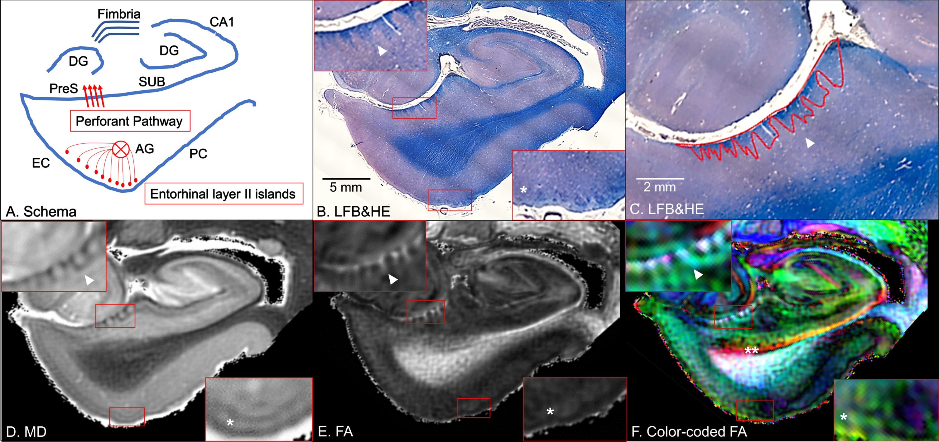 Coronal panels of the left entorhinal cortex (EC) in non-Alzheimer’s disease brain tissue. A) Schematic diagram. The perforant pathway is a set of fibers projecting from the entorhinal layer II islands through the angular bundle (AG) and the presubiculum (PreS) to the dentate gyrus (DG) in the hippocampus. PC, perirhinal cortex; SUB, subiculum. B) Luxol fast blue with hematoxylin and eosin staining (LFB&HE). The red bounding boxes are 5×magnified to clearly visualize the perforant path fibers on the presubiculum (left-upper panel) and the entorhinal layer II islands (right-lower panel). C) The red bounding areas are myelinated fibers in the presubiculum. D) Mean diffusivity (MD) map. E) Fractional anisotropy (FA) map. F) Color-coded FA map. Arrowheads point to myelinated fibers in the presubiculum and single asterisks denote the entorhinal layer II cortices (B–F). Double asterisk designates the temporal alvear pathway coursing around the hippocampal fissure (F).