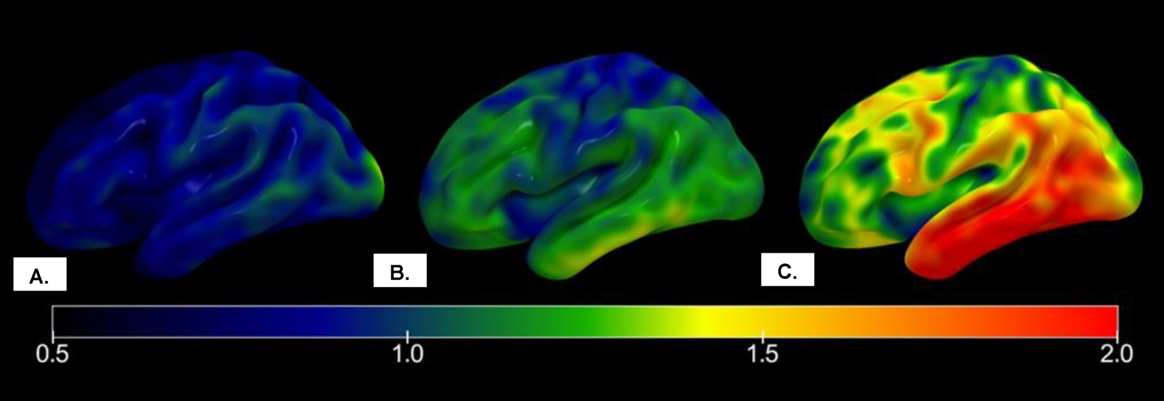 Mean right hemispheric 18F-Flortaucipir SUVR maps of participants with normal cognition, mild cognitive impairment, and Alzheimer’s disease in ADNI. A) Tau maps for a participant classified as T– by both TOC and Chen pathologic staging schemes. B) Tau map for participant classified as T+ by Chen staging scheme but T– by TOC staging scheme. C) Tau map for participant classified as T+ by both TOC and Chen staging schemes. SUVR, standardized uptake value ratio; ADNI, Alzheimer’s Disease Neuroimaging Initiative.