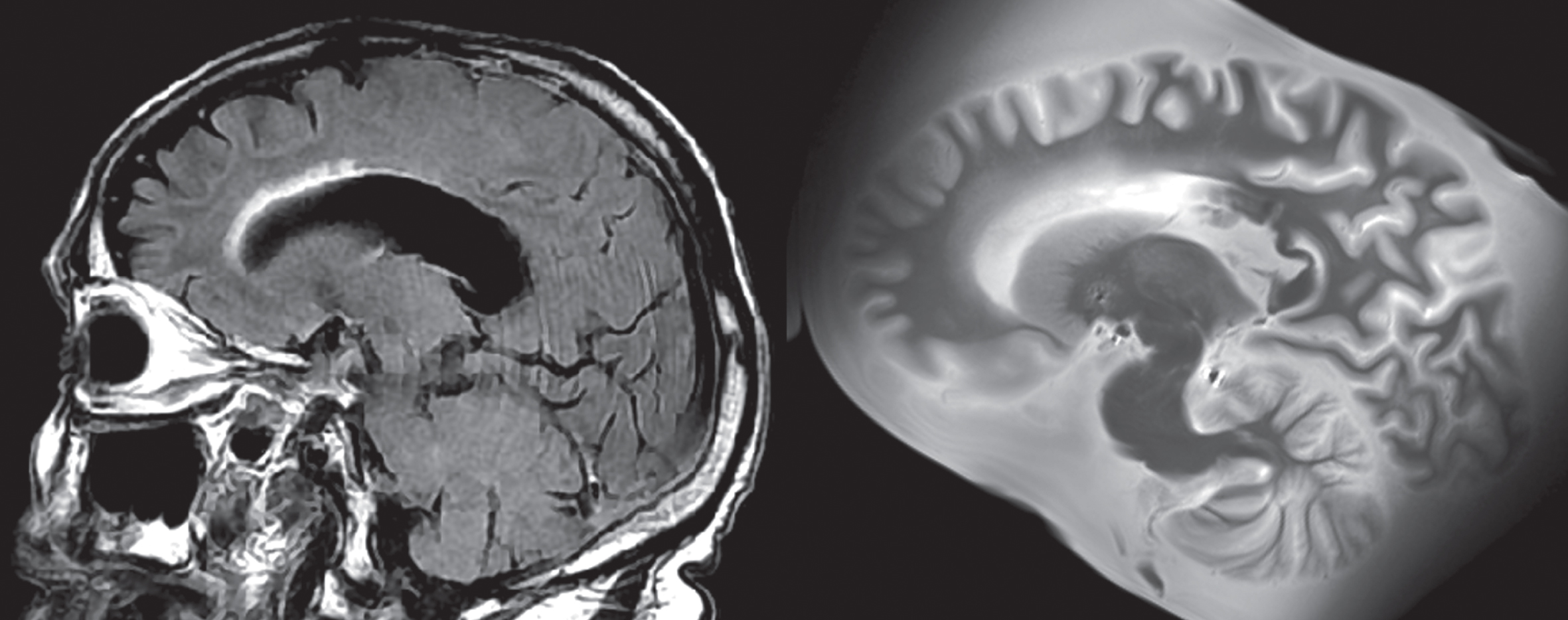 Example of lesion progression. The antemortem clinical scan was performed in 2014, while the postmortem scan was completed in 2020, several months after passing. The WMH around the frontal horn of the lateral ventricle has increased during this time. The total WMH volume increased from 10.2 cm3 (in 2014) to 14.5 cm3 (in 2020) during this time.