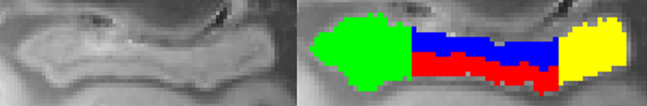 Hippocampus segmentation. The hippocampus is segmented into anterior (green), posterior (yellow), dentate gyrus (blue), and middle non-dentate hippocampus (red). The orientation of the hippocampus is such that its longest axis is horizontal to facilitate segmentation of hippocampal head, body, and tail [107, 108].