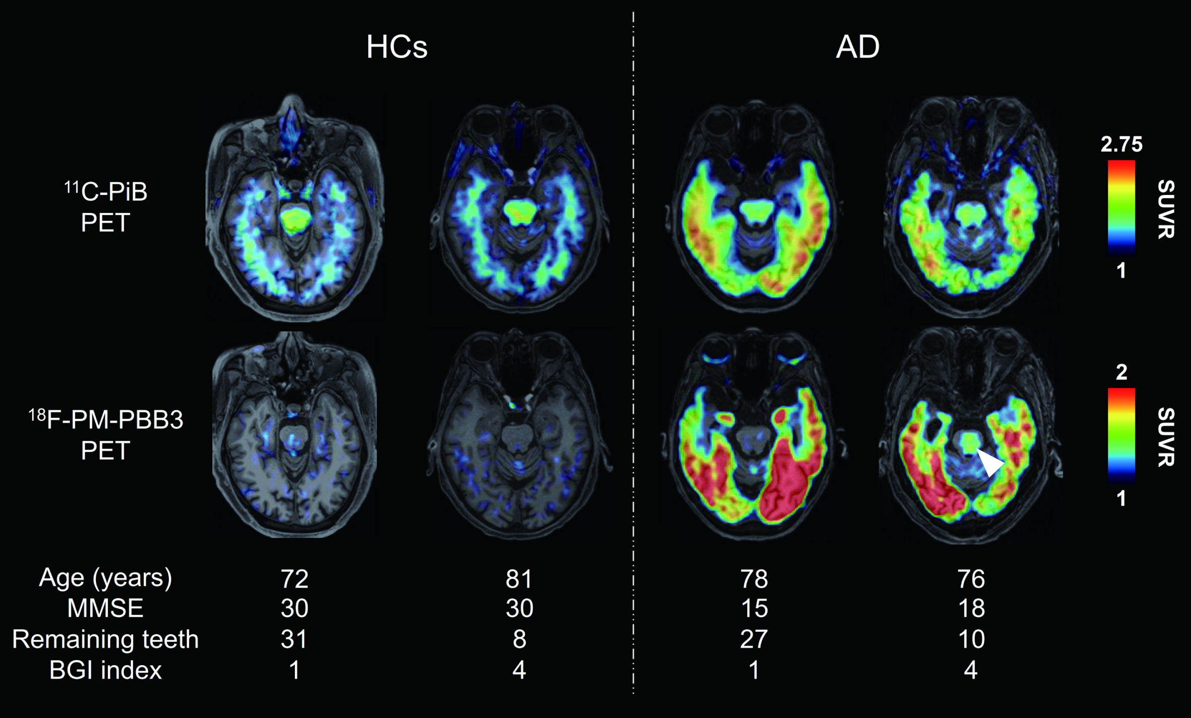 Representative PET images of Aβ and tau in HCs and AD-spectrum patients. Axial 11C-PiB (Aβ) and 18F-PM-PBB3 (tau) PET images of individual participants. PET images were coregistered with the individual anatomical magnetic resonance images. Representative PET images were shown according to participant group, and good and poor oral condition, respectively. White arrowhead indicates tau PET tracer binding in the brainstem. Tau PET tracer retention was increased in the brainstem in a subset of AD-spectrum patients with poor oral parameters compared with HCs. AD, Alzheimer’s disease; BGI, biofilm–gingival interface; HCs, healthy controls; MMSE, Mini Mental State Examination; PET, positron emission tomography; SUVR, standard uptake value ratio.