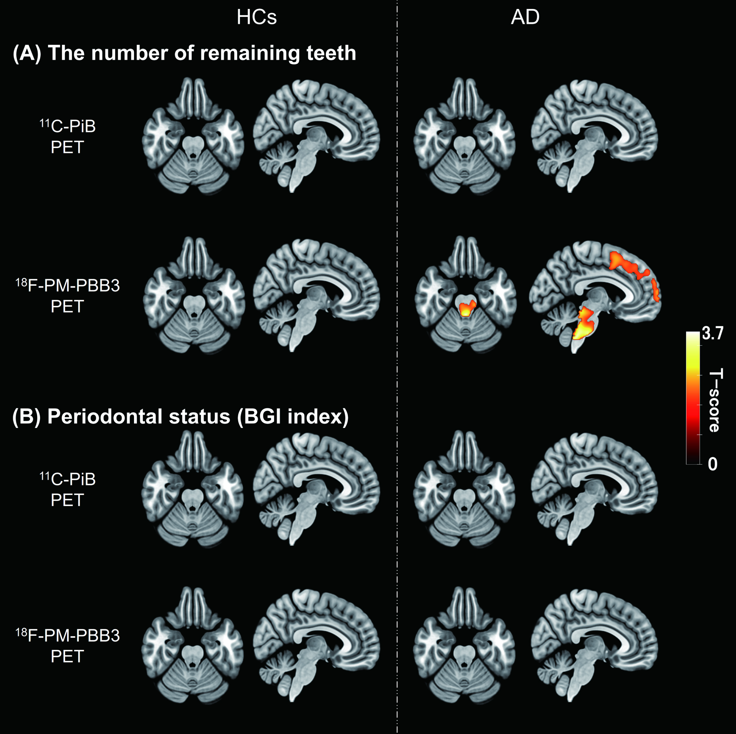 Correlations between oral parameters and PET tracer retention. A) T-score maps of correlation analyses between the number of remaining teeth and each PET tracer retention in HCs and AD-spectrum patients. B) T-score maps of correlation analyses between periodontal status (BGI index) and each PET tracer retention in HCs and AD-spectrum patients. Regions with significant correlations indicated an increase of tau PET tracer accumulation with a decrease in the number of remaining teeth (uncorrected, p < 0.05). The cluster size threshold was set to the expected voxel of each analysis. Results were expressed in the MNI coordinate space. AD, Alzheimer’s disease; BGI, biofilm–gingival interface; HCs, healthy controls; MNI, Montreal Neurological Institute; PET, positron emission tomography.