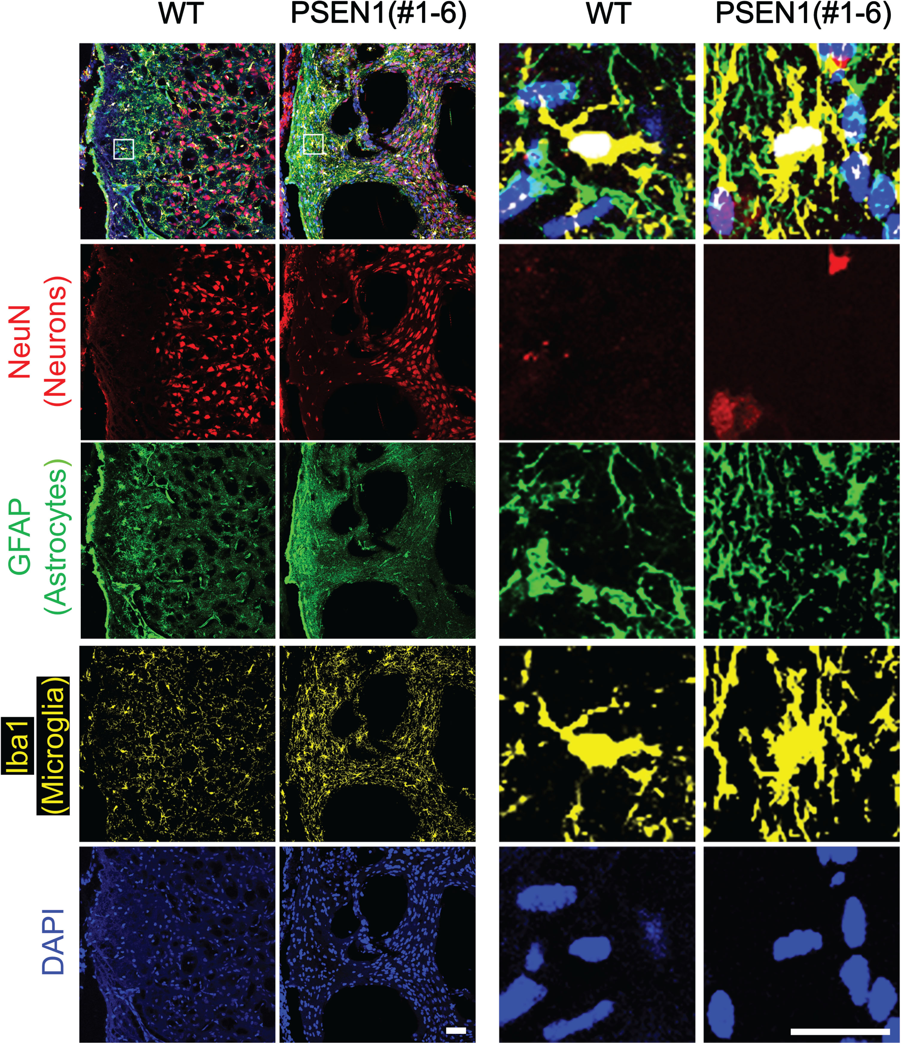 Abnormal neural cells in PSEN1 knockout newborn pigs. Immunohistochemistry was used to identify the distribution of neuronal cells in the frontal cerebral cortex of PSEN1 knockout pigs. Cells positive for markers representing astrocytes (GFAP) and microglia (Iba1) were clustered in the brain of PSEN1 knockout pigs compared to an age-matched wildtype control. Scale bars indicate 100μm.