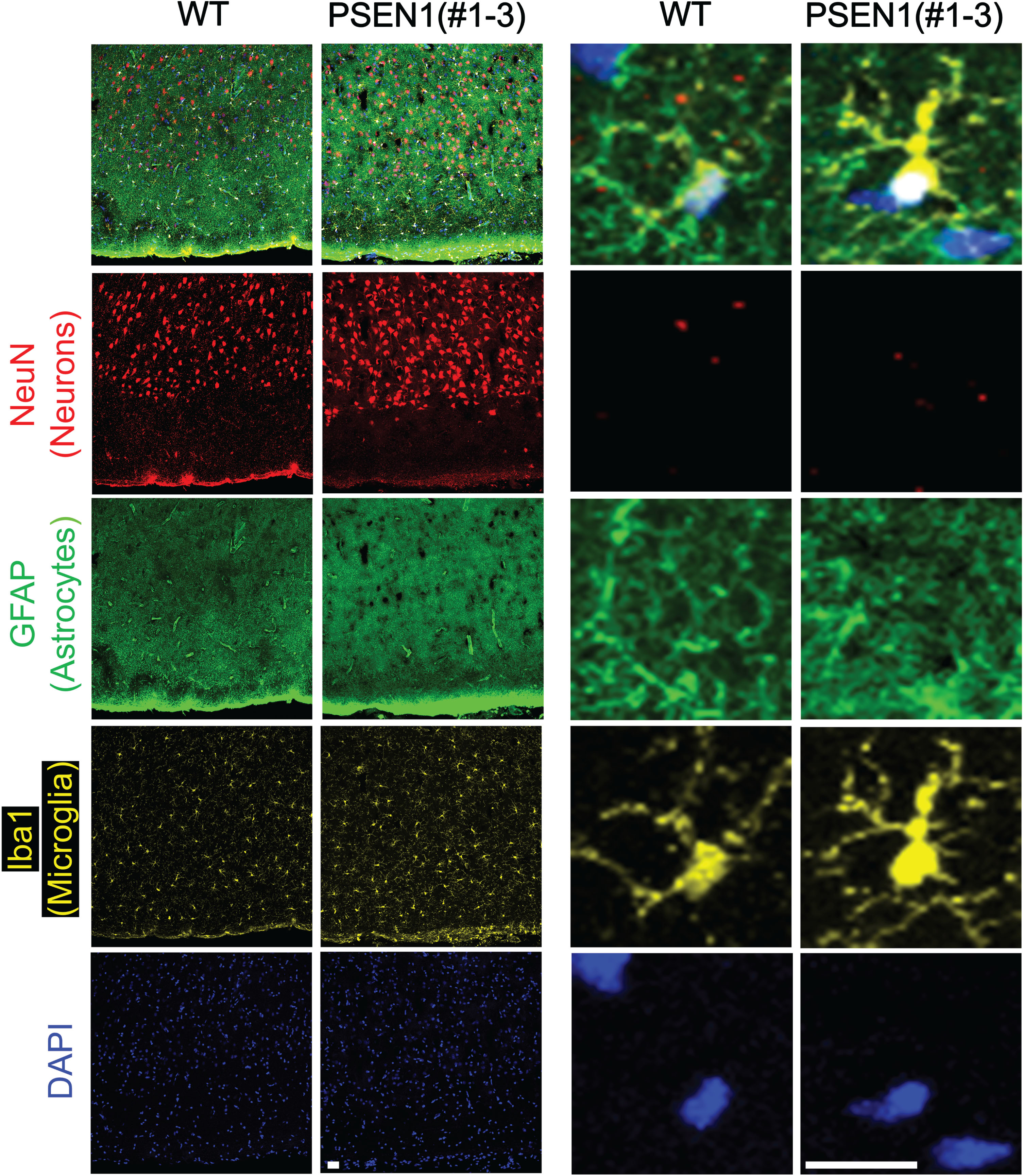 Abnormal neural cells in PSEN1 adult pigs. Immunohistochemistry was used to identify the distribution of neuronal cells in the frontal cerebral cortex of PSEN1 mutant pigs. Cells positive for markers representing astrocytes (GFAP) and microglia (Iba1) were clustered in the brain of PSEN1 knockout pigs compared to an age-matched wildtype control. Scale bars indicate 100μm.