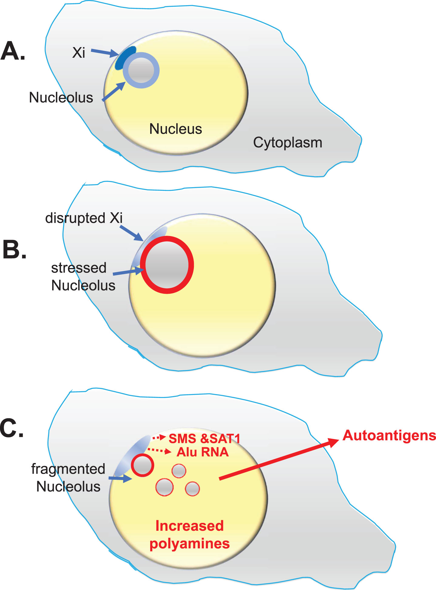 Lupus Scenario. This scenario from the “X chromosome-nucleolus nexus” hypothesis was proposed for autoimmune diseases, especially SLE, to explain the female bias of autoimmune diseases based on involvement and vulnerability of the inactive X chromosome (Xi) with its normally epigenetically silenced polyamine gene alleles and a high concentration of Alu elements in the X’s pseudo-autosomal region 1 (PAR1). A) The Xi, a dense heterochromatic structure, localizes to the nuclear periphery (at the nuclear envelope) with approximately 75-85% of Xi genes epigenetically suppressed. The Xi (aka, the “nucleolar satellite” or “Barr body”) is typically next to a nucleolus where the Xi can be impacted by nucleolar dynamics during a cellular stress response. B) Stress can increase polyamine levels which causes expansion of the nucleolus, disrupting the Xi and opening previously sequestered gene alleles. C) Previously silent Xi genes at Xp22, spermine synthase (SMS) and spermidine/spermine-1-acetyltransferase (SAT1), could be expressed, further increasing polyamine synthesis and recycling. In addition, an abundance of Alu elements in PAR1 can be opened for expression by RNA pol III. RNA pol III Alu RNA transcripts compete with structural RNAs for binding nucleolin, thereby disrupting nucleolar integrity and releasing high levels of nucleolar polyamines and formation of autoantigens such as Z-DNA. Expression of a “hot” LINE-1, also at Xp22, could lead to reverse transcription.