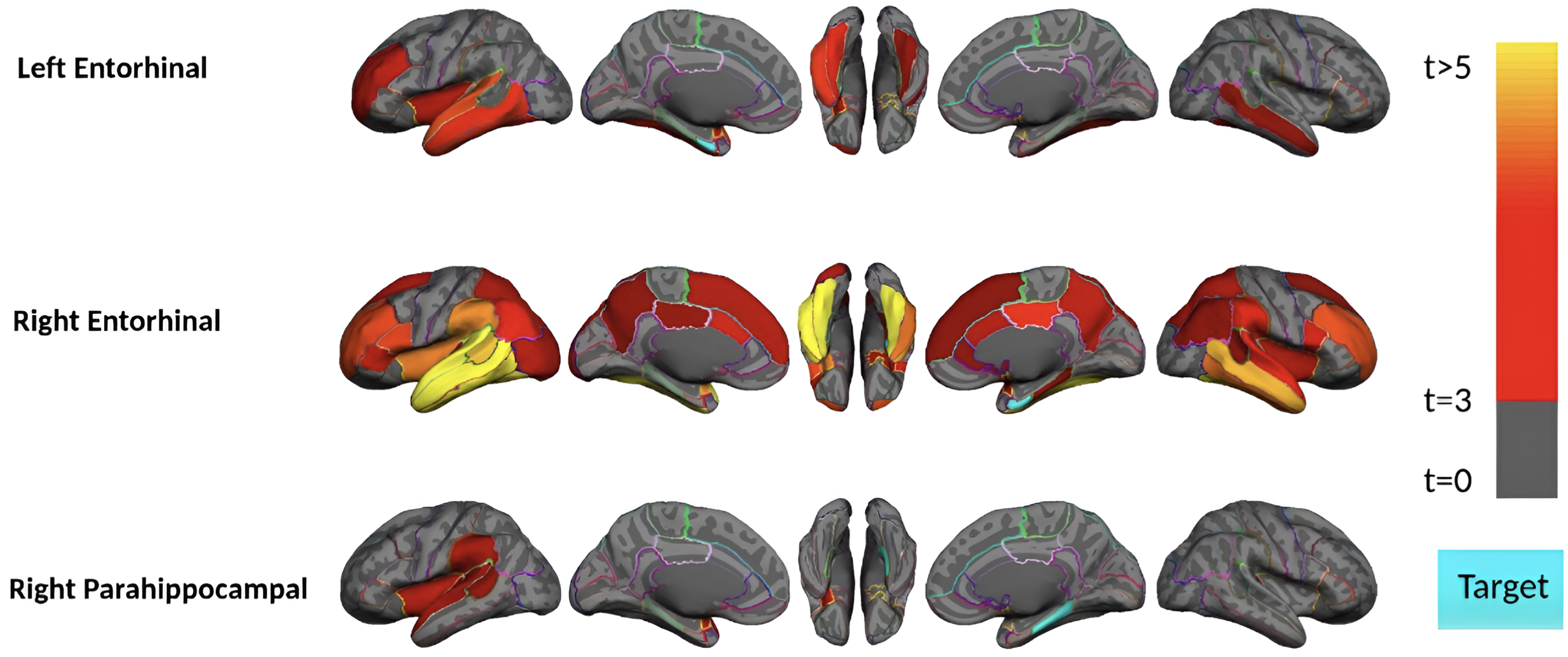 Region-wise statistical map (t-value) of remote association between tau deposition in three target regions and regional Aβ depositions in 67 cortical regions obtained in the pre-acceleration phase of tau deposition. The family-wise corrected t-value at each region is color-coded with red or yellow colors representing increasing positive t-values and overlaid on the semi-inflated cortical surface of the MNI152 template. The red color indicates the t-value is equal to 3, and the yellow color indicates the t-value is higher than 5. The target region is indicated as light blue.