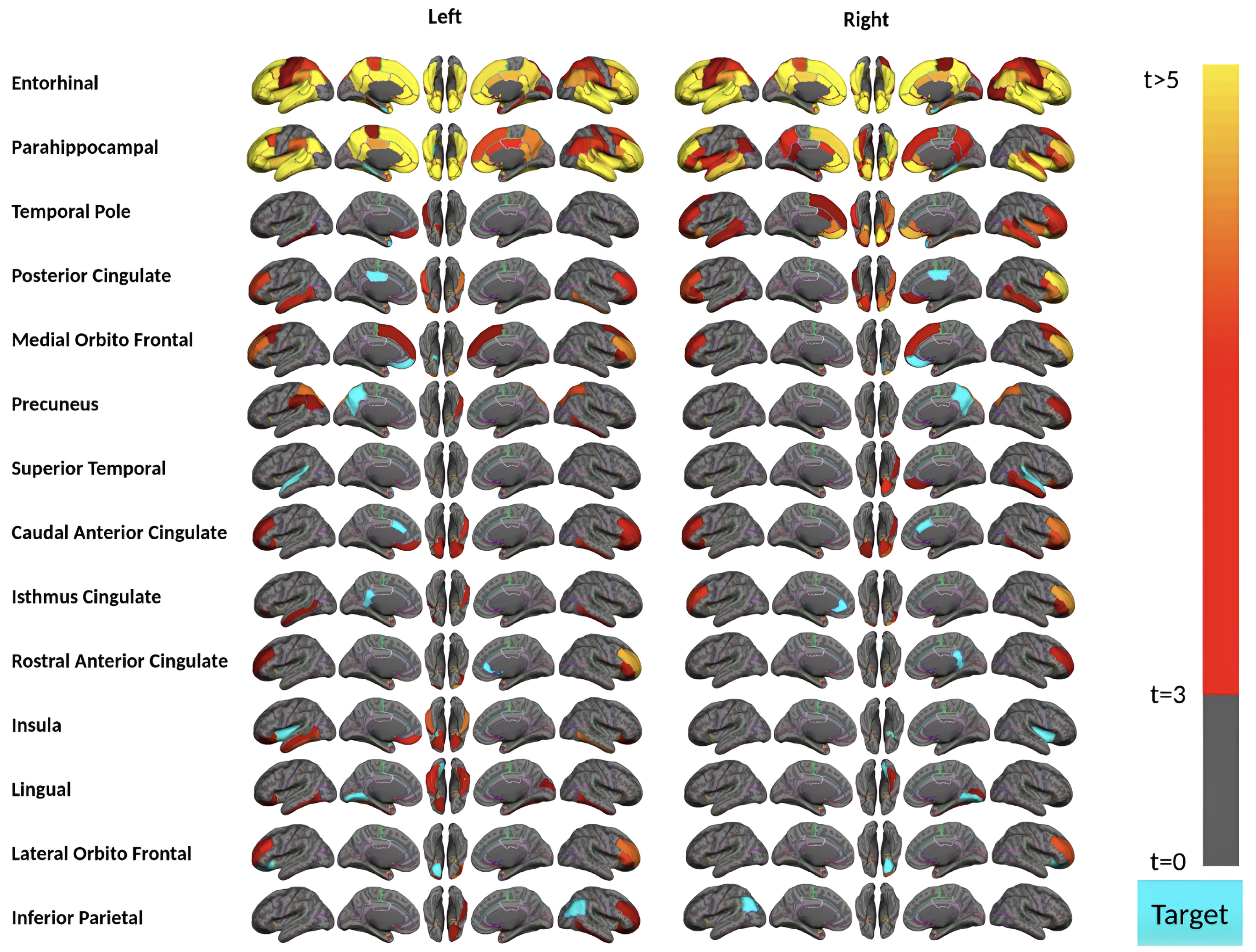 Region-wise statistical map (t-value) of remote association between tau deposition in fourteen target regions and regional Aβ depositions in 67 cortical regions obtained in the acceleration phase of tau deposition. The family-wise corrected t-value at each region is color-coded with red or yellow colors representing increasing positive t-values and overlaid on the semi-inflated cortical surface of the MNI152 template. The red color indicates the t-value is equal to 3, and the yellow color indicates the t-value is higher than 5. The target region is indicated as light blue.