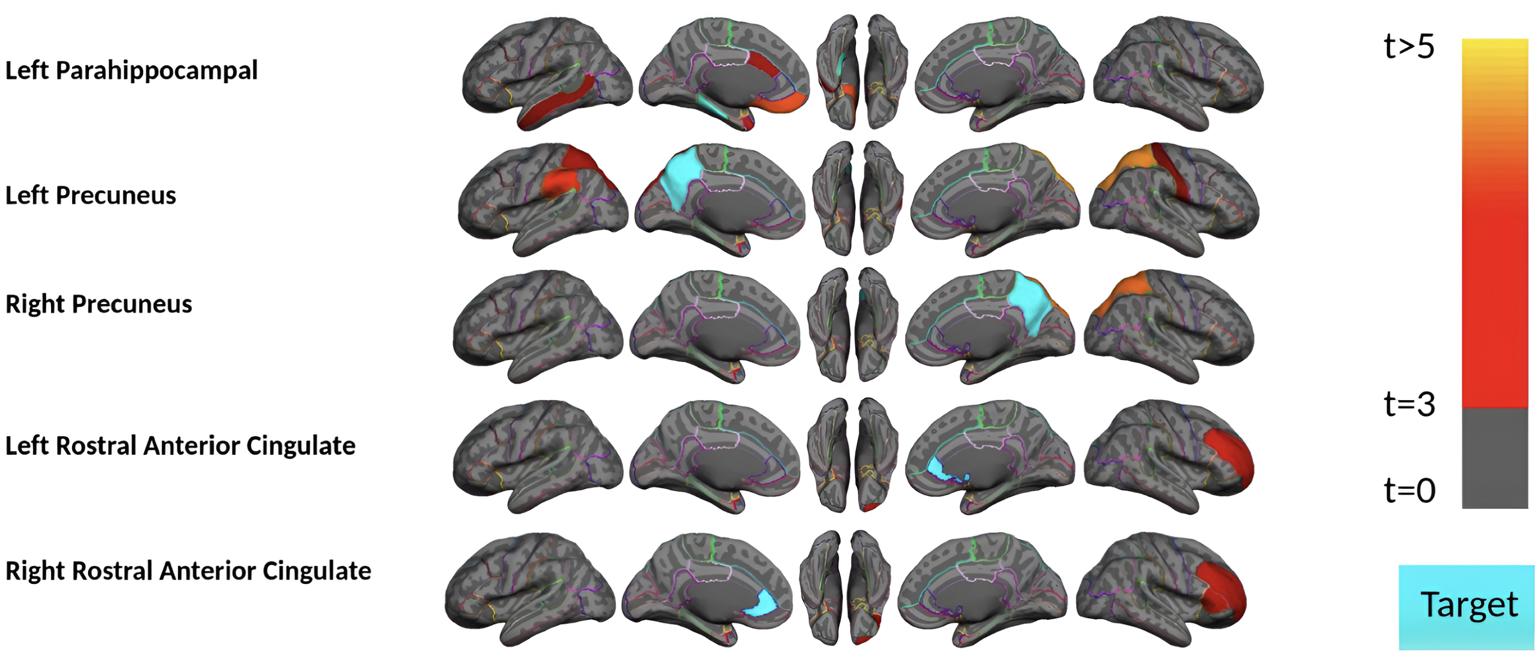 Region-wise statistical map (t-value) of remote association between tau deposition in five target regions and regional Aβ depositions in 67 cortical regions obtained the MCI and mild AD subject in the acceleration phase of tau deposition. The family-wise corrected t-value at each region is color-coded with red or yellow colors representing increasing positive t-values and overlaid on the semi-inflated cortical surface of the MNI152 template. The red color indicates the t-value is equal to 3, and the yellow color indicates the t-value is higher than 5. The target region is indicated as light blue.