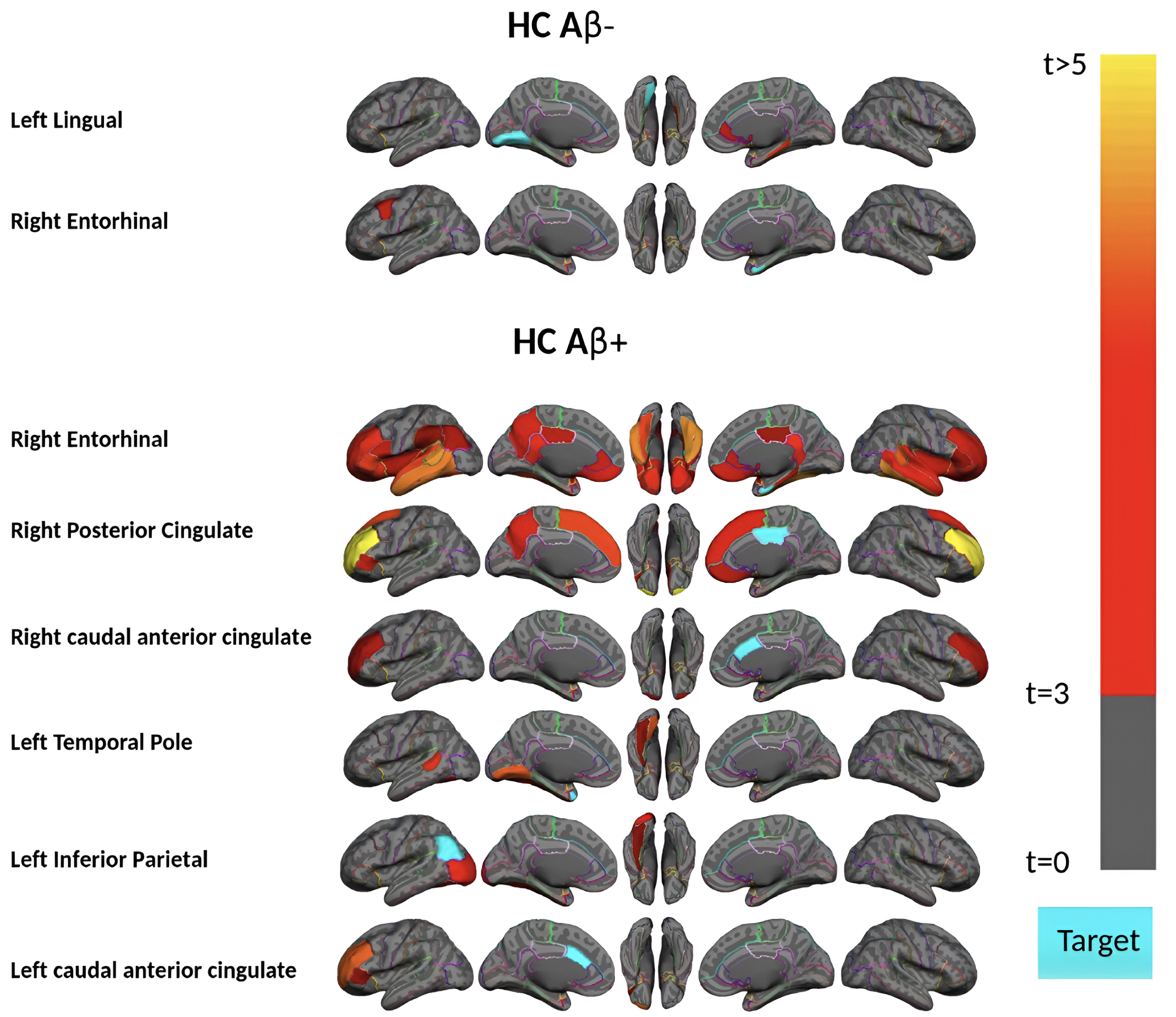 Region-wise statistical map (t-value) of remote association between tau deposition in six target regions and regional Aβ depositions in 67 cortical regions obtained in the HC Aβ–and Aβ+ subjects in the acceleration phase of tau deposition. The family-wise corrected t-value at each region is color-coded with red or yellow colors representing increasing positive t-values and overlaid on the semi-inflated cortical surface of the MNI152 template. The red color indicates the t-value is equal to 3, and the yellow color indicates the t-value is higher than 5. The target region is indicated as light blue.