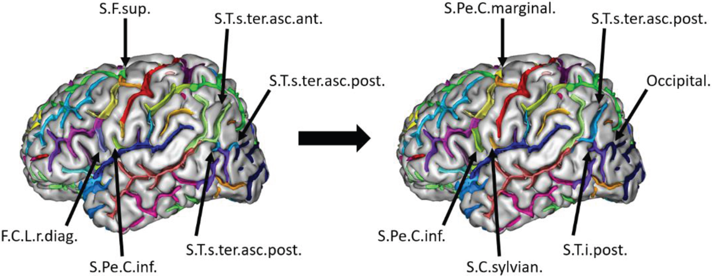 Example of the relabeling performed on sulcal nodes in the left hemisphere of a converter MCI patient. The colors correspond to those of the BrainVISA atlas. The anterior and posterior branches of the superior temporal sulcus (S.T.s.) were relabeled, as well as a portion of the posterior inferior temporal suclus (S.T.i.post.) and the occipital sulcus; in the frontal area, the classification of the central sylvian sulcus (S.C.sylvian.) and the inferior precentral sulcus (S.Pe.C.inf) were corrected. S.F.sup., superior frontal sulcus; S.T.s.ter.asc.ant., anterior terminal ascending branch of the superior temporal sulcus; S.T.s.ter.asc.post., posterior terminal ascending branch of the superior temporal sulcus; S.Pe.C.inf., inferior precentral sulcus; F.C.L.r.diag., diagonal ramus of the lateral fissure; S.Pe.C.marginal., marginal precentral sulcus.