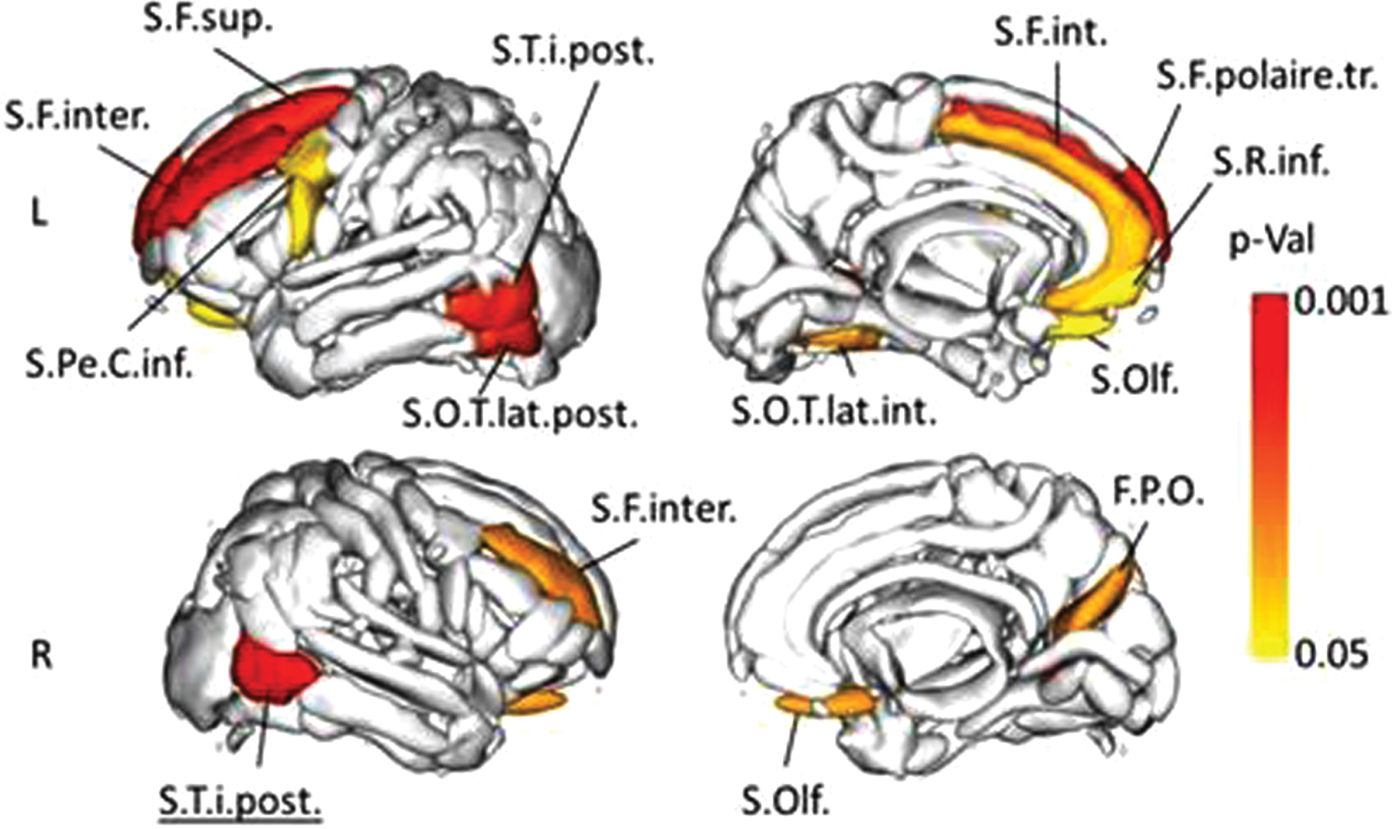 Representation of the sulci whose width exhibited a statistically different value between MCIc and MCInc. The color intensity describes the significance of the result (MCIc > MCInc). S.T.i.post., posterior inferior temporal sulcus; S.F.inter., intermediate frontal sulcus; S.F.sup., superior frontal sulcus; S.F.polaire.tr., polar frontal sulcus; S.O.T.lat.post., posterior occipito-temporal lateral sulcus; S.O.T.lat.int., internal occipito-temporal lateral sulcus; S.Pe.C.inf., inferior precentral sulcus; S.Olf, olfactory sulcus; S.F.int., internal frontal sulcus; F.P.O., parieto-occipital fissure; S.R.inf., inferior rostral sulcus.