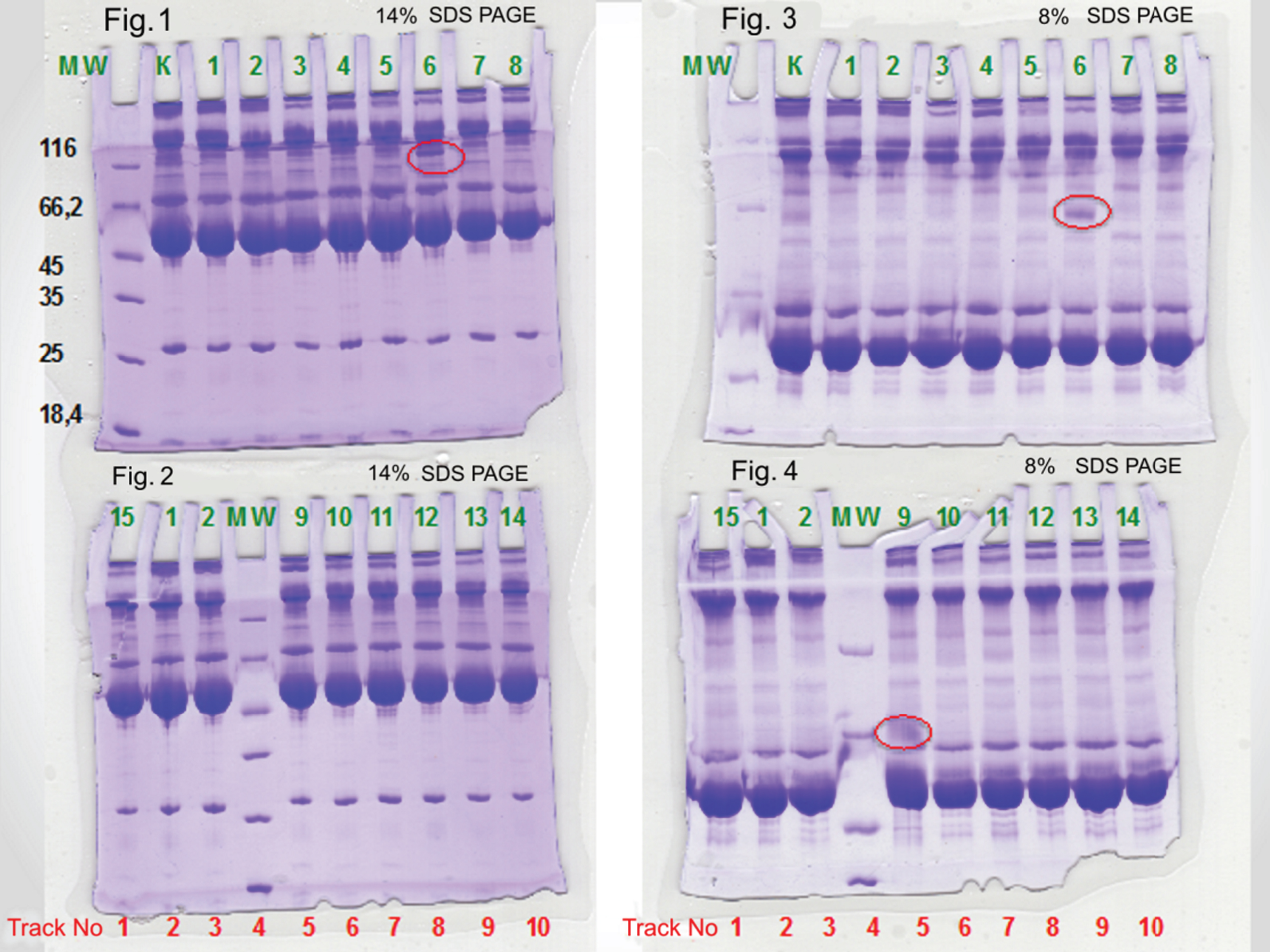 1-D electrophoresis of plasma of 14% and 8% SDS PAGE. Figures 1 and 2 Individual plasma samples 14% SDS PAGE. Figures 1 and 2 1-D-electrophoretogram plasma proteins. 1st track - proteins - markers MW. 2nd track - control pools of blood plasma. 3rd track - a clinically healthy subject 1. 4th track - a clinically healthy subject 2. 5th track - patient 3. 6th track - patient 4. 7th track - patient 5. 8th track - patient 6. 9th track - patient 7. 10th track - patient 8. Figures 3 and 4 Individual plasma samples 8% SDS PAGE. Figures 3 and 4 1-D electrophoretogram plasma proteins of the blood of D2TM patients of the blood of D2TM patients. 1st track - control pools of blood plasma. 2nd track - a clinically healthy subject 1. 3rd track - a clinically healthy subject 2. 4th track - markers MW. 5th track - patient 9. 6th track - patient 10. 7th track – patient 11. 8th track – patients 12. 9th track - patients 13. 10th track - patients 14.
