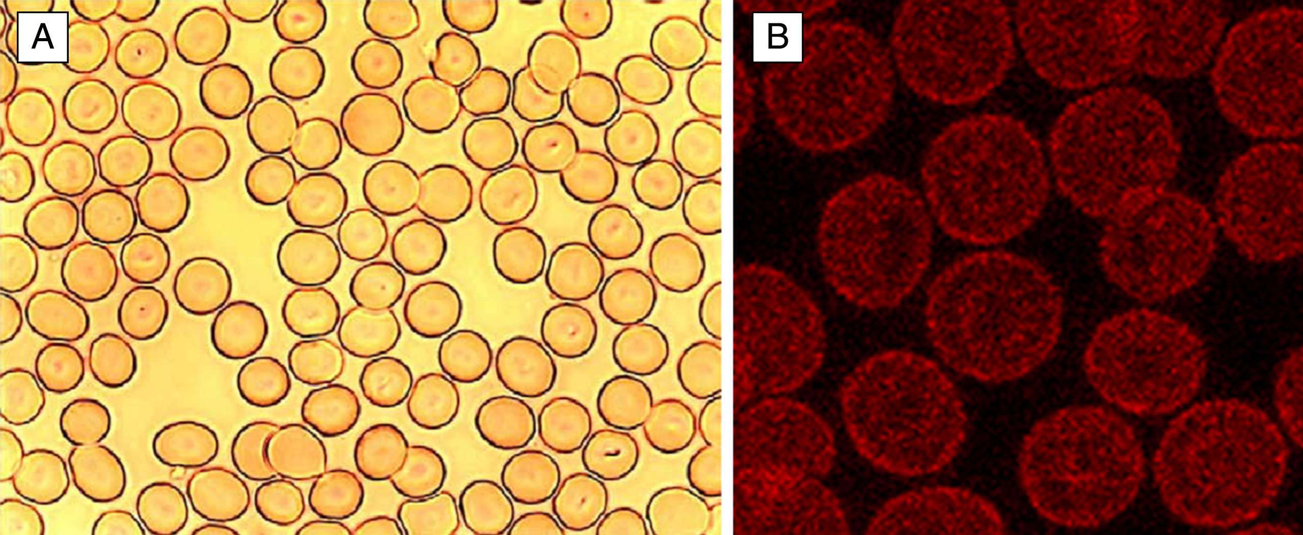 Normal human discocytes on a glass cover slip in autologous plasma. A: light microscopy, B: Phalloidin-rhodamine stained actin in discocytes visualized with a confocal laser scanning microscope.