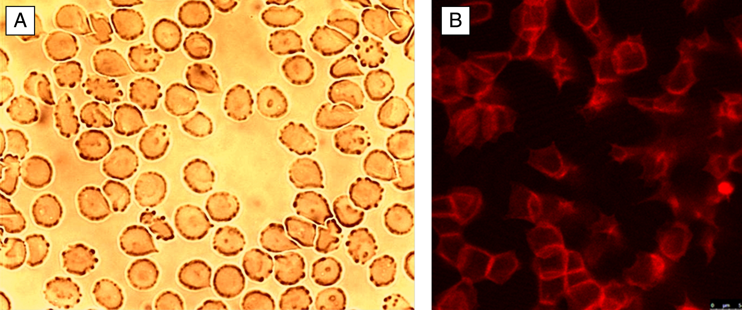 Echinocytes on a glass cover slip in autologous plasma. A: light microscopy, B: actin stained (phalloidin-rhodamine) erythrocytes visualized with laser scanning microscope.