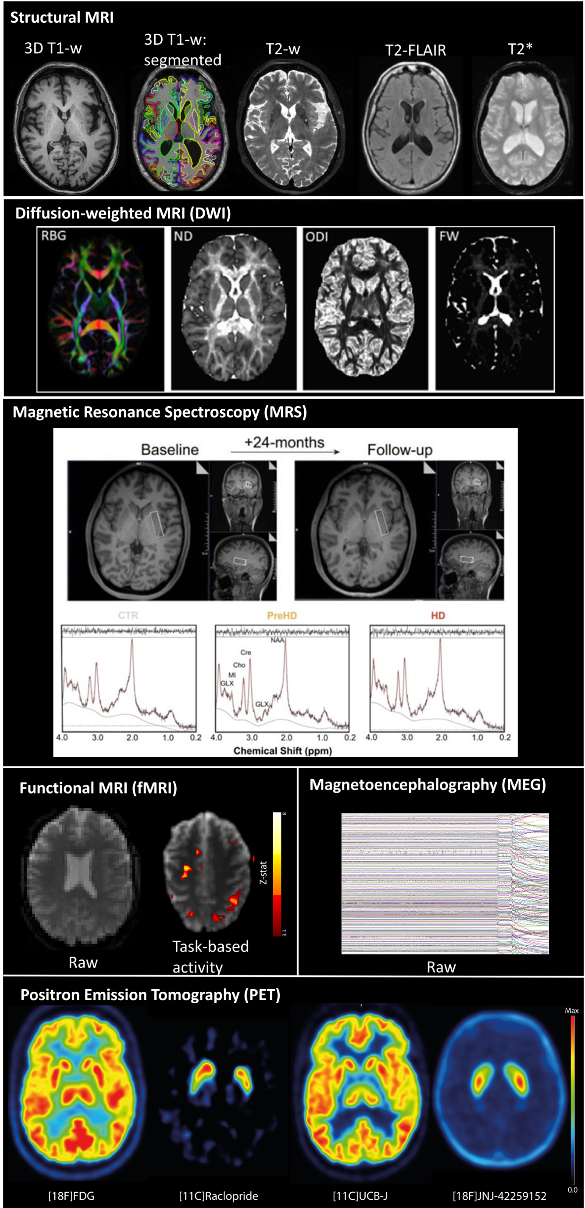 Examples of individual subject-level data for each imaging modality. Structural MRI: Axial images showing 3D T1-weighted and T2-weighted scans from the TRACK-HD study. T2 FLAIR and T2* scans are adapted from Duchesne et al. 2019. 3D T1-weighted scan is segmented using MALP-EM [263]. DWI: Neurite Orientation Dispersion and Density Imaging (NODDI) maps. RGB: reg-green-blue colour map indicating eigenvector orientation, ND: neurite density map, ODI: orientation dispersion index map, FW: extracellular free water map (adapted from Kraguljac et al 2021). MRS: Single-voxel Proton MRS: Left Putamen Voxel Placement and LCModel Spectra in Controls and in HD (adapted from Lowe et al., [146]). LCModel outputs: raw spectra (black) and model fits (red); concentrations shown in parts per million (ppm). NAA, N-acetylaspartate; MI, myo-inositol; Cre, creatine; Cho, choline; GLX, glutamate  +  glutamine; PreHD, gene expansion carriers with UHDRS diagnostic confidence level (DCL) < 4 and CAG repeat length > 40; HD, gene expansion carriers with DCL = 4 and CAG repeat length > 36; CTR, clinically well individuals, of a similar age to gene expansion carriers. Functional MRI: Image on the left is a slice from a single EPI volume of a task fMRI timeseries. The image on the right shows a heatmap overlaid on a single EPI volume. The heatmap is produced after fitting a GLM and represents the activity (z-stat) when responding to the n-back task (all conditions, including 0-back) vs. rest. MEG: Raw MEG data (adapted from Proudfoot et al. [264]). Two channels contain obvious artefacts. The door to the magnetically shielded room is opened after 4 seconds of recording. The interference caused by external magnetic fields highlights why effective room shielding is essential. PET: Axial images showing radiotracer uptake in healthy controls for [18F]FDG (glucose metabolism), [11C]Raclopride (dopamine D2 Receptor), [11C]UCB-J (synaptic vesicle protein 2A) and [18F]JNJ-42259152 (phosphodiesterase 10A). References: Diffusion Weighted MRI from figure 1 is reprinted from Neuroimage Reports Volume 1 (1), Kraguljac NV, Monroe WS, Anthony T, Jindal RD, Hill H, Lahti AC. Neurite orientation dispersion and density imaging (NODDI) and duration of untreated psychosis in antipsychotic medication-naive first episode psychosis, p 100005, 2021, with permission from Elsevier. T2 Flair and T2* scans from figure 1 are adapted from Scientific Data Volume 6, Duchesne S, Dieumegarde L, Chouinard I, Farokhian F, Badhwar A, Bellec P, Tétreault P, Descoteaux M, Boré A, Houde JC, Beaulieu C, Potvin O. Structural and functional multi-platform MRI series of a single human volunteer over more than fifteen years, p 645, 2019, published by Nature. Published under the Creative Commons Attribution 4.0 https://creativecommons.org/licenses/by/4.0/