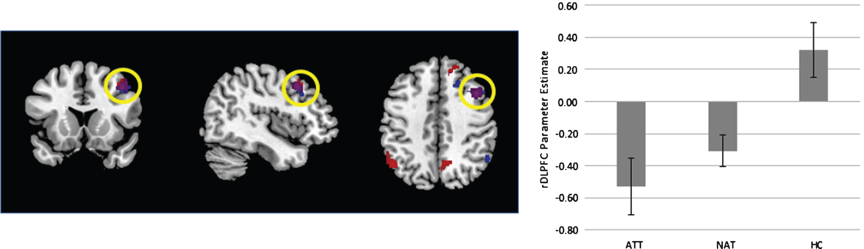 Left - Display of the contrast of ATT vs controls (blue) and both patient groups vs controls (red). Overlap is signified in purple. Contrast thresholded at p < 0.001 uncorrected for display purposes. Right – extracted parameter estimates from the right dorsolateral prefrontal cortex (rDLPFC), plotted for each group. Error bars reflect standard error of the mean.