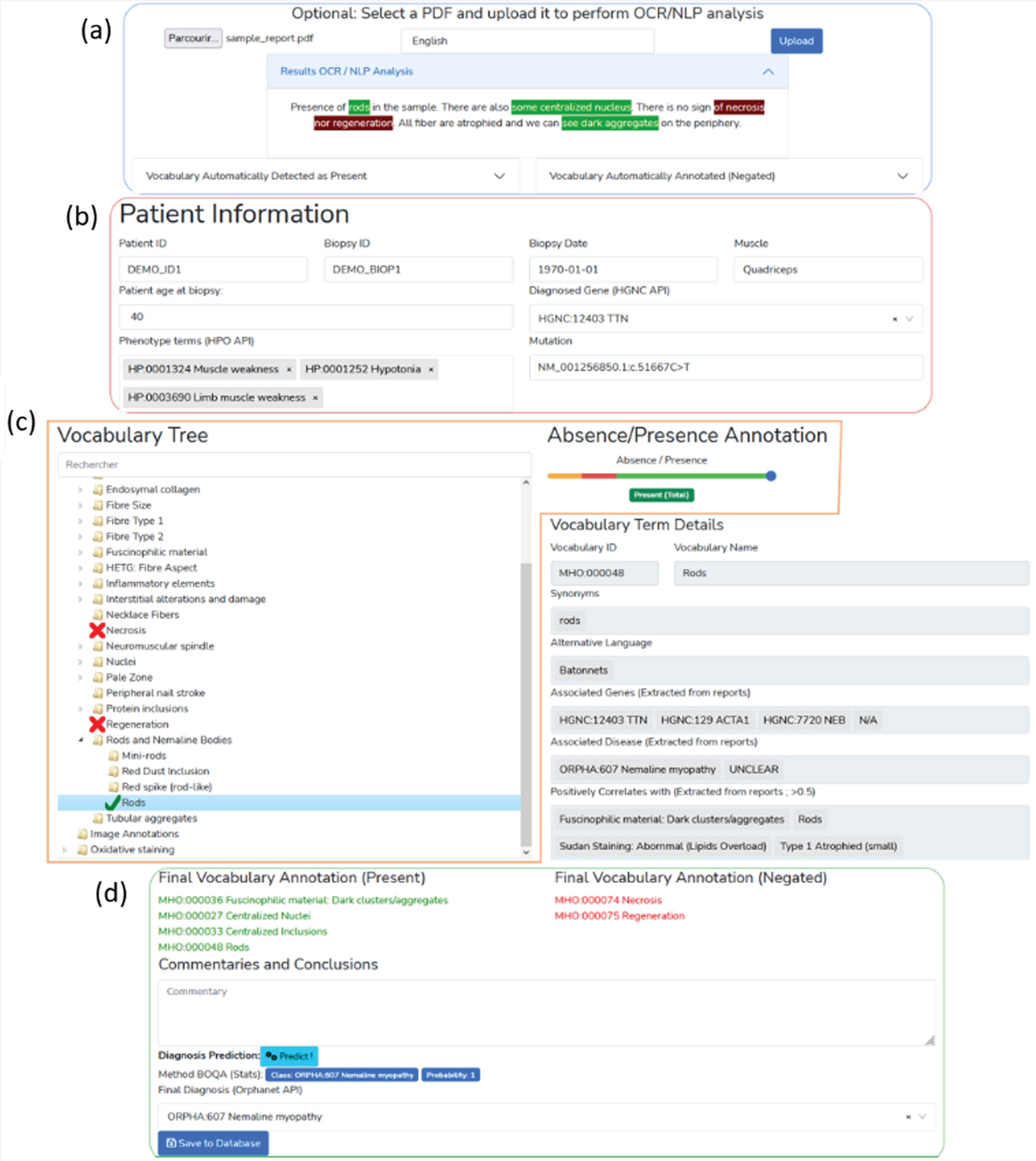 
Screenshot of the interface for the report digitalization module. (a) PDF upload section for automatic keyword detection in the text. Detected keywords have a green background, detected and negated keywords have a red background. (b) Patient information section (age, document ID, gene, mutation, phenotype). (c) Standard vocabulary tree viewer to select keywords with associated slider to manually indicate keyword value (absence or presence level). Keywords marked as present are indicated with a green check mark, absent keywords are marked with a red cross. (d) Overview section of all annotated terms, diagnosis selection and commentaries with automatic diagnosis support using the BOQA algorithm.