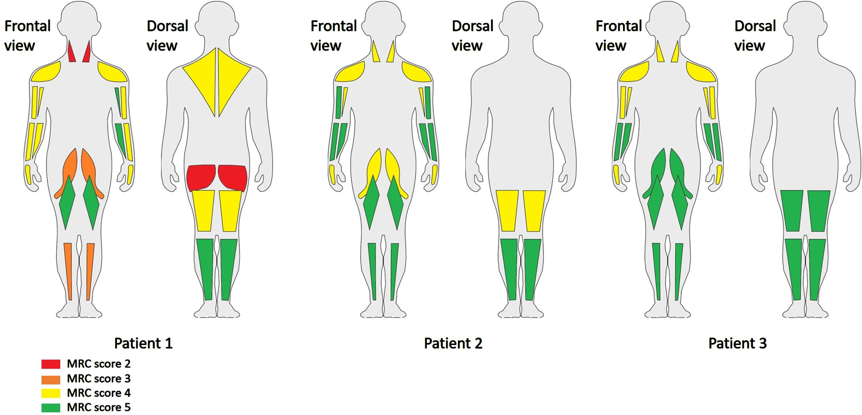 MRC scores of the patients in individual muscles. Legend: As patient 2 and 3 could not turn to their abdomen, the neck and hip extensors were not tested.