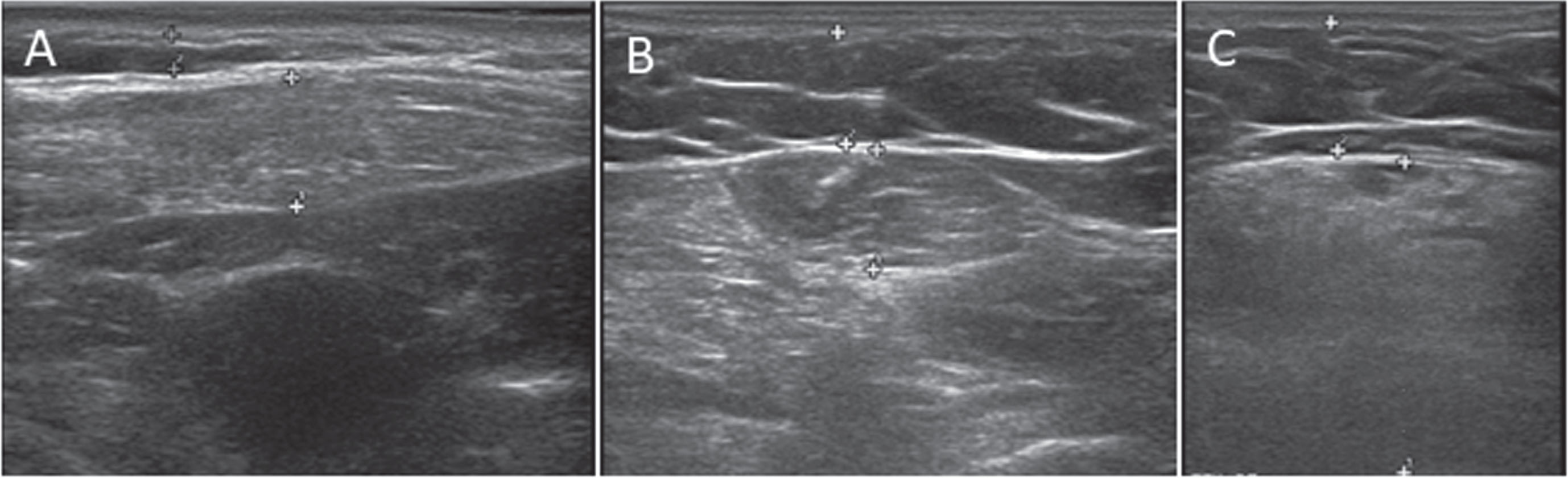 Increased echogenicity on muscle ultrasound. (A) sternocleidomastoid muscle of patient 3. (B) flexor carpi radialis muscle of patient 3. (C) rectus femoris muscle of patient 2.