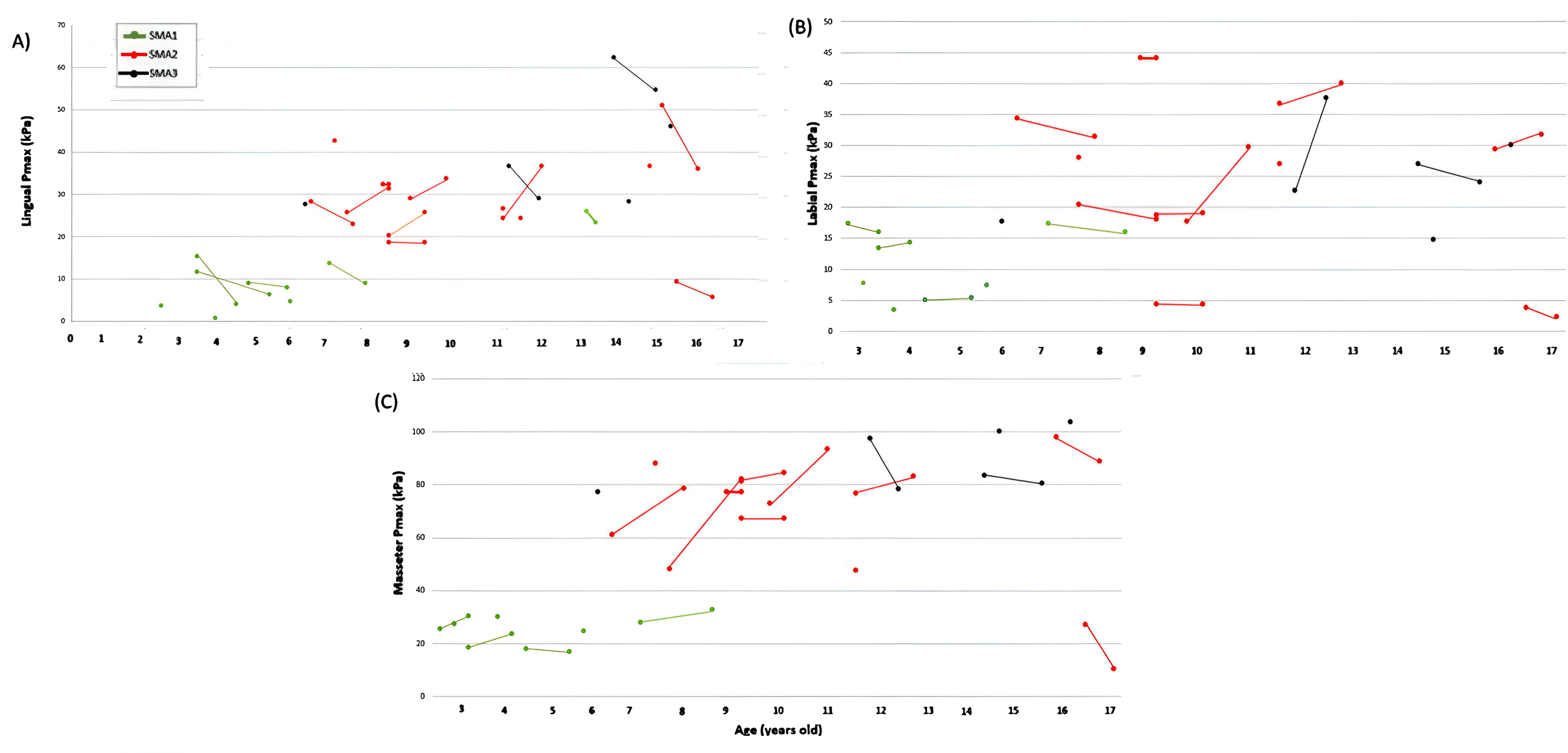 Evolution of individual lingual (A), labial (B), and masseter (C) Pmax values at a 1-year interval according to SMA type (n = 17). SMA: spinal muscular atrophy.