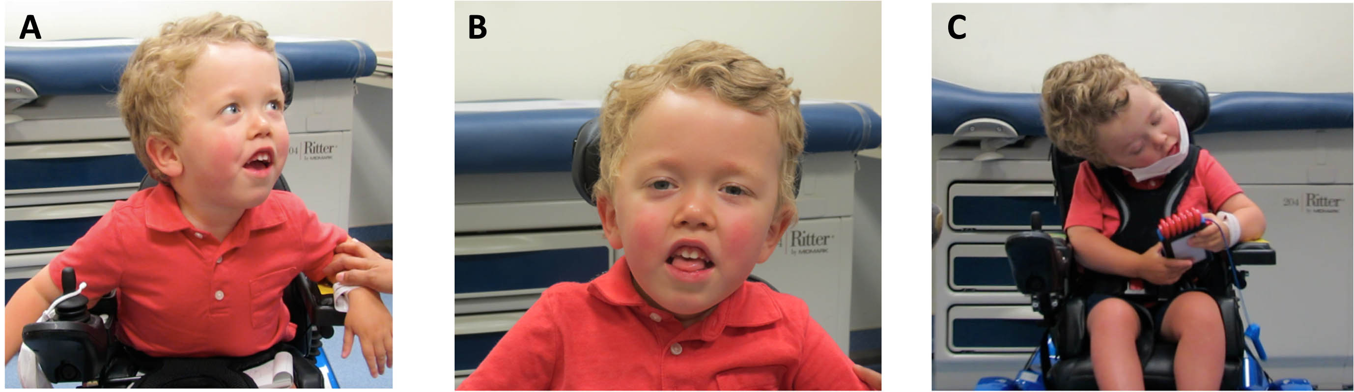 Classical clinical phenotype of LAMA2-RD in a patient (age 43 months) who obtained a maximal motor milestone of sitting (“Sit” subgroup). Clinical images demonstrating: (A) hyperlordotic sitting posture, (B) facial weakness with mouth maintained in an open position, and (C) axial weakness with neck extension weakness. [Permission to publish images provided by the patient’s family].