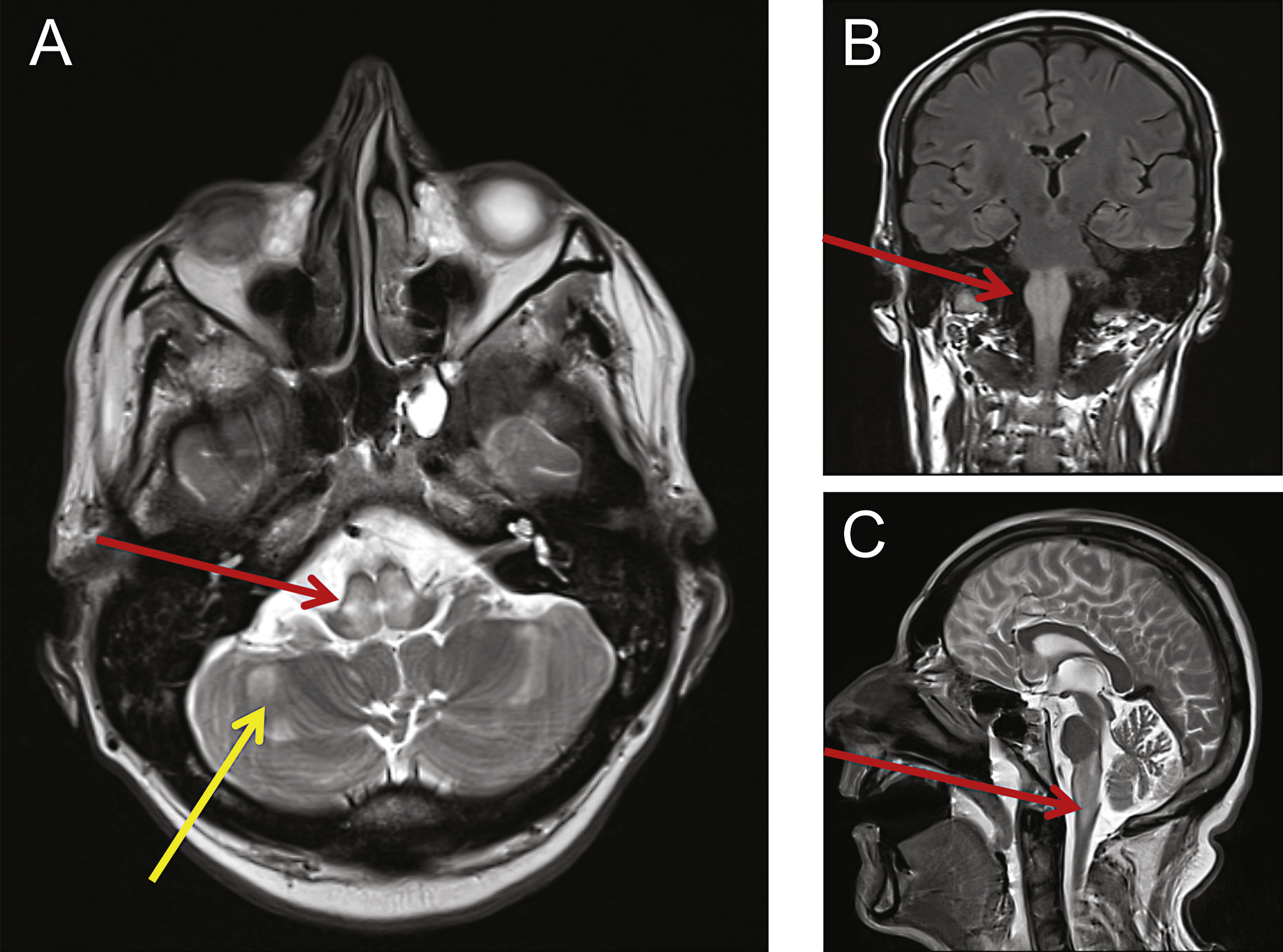 MRI revealed abnormalities consistent with mitochondrial disease. Cranial MRI was performed showing swelling and abnormal high T2-weighted signal changes centrally within the dorsal pons (A, red arrow) and medulla (B, C red arrows). Other small foci of restricted diffusion were detected and also seen within the cerebellar hemispheres (A, yellow arrow).
