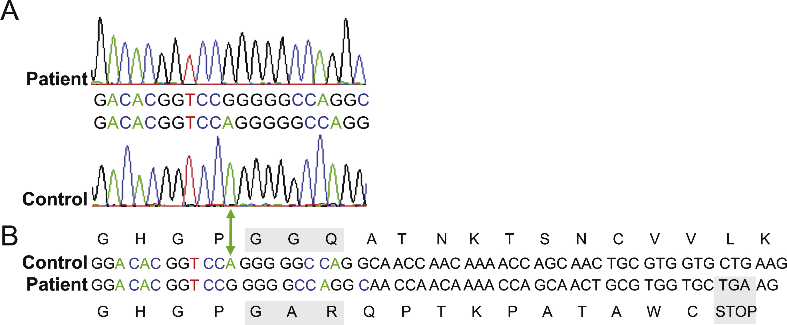 Sanger sequence analysis of C12orf65 patient gene. A. Region of an  electropherogram of Sanger sequencing of the C12orf65 gene from the patient (upper panel)  and wildtype control (lower panel), aligned to the GenBank accession: NM_152269.4 [19]. The green arrow indicates the position of the adenine nucleotide in control sample that is deleted from the patient’s genome. B. Schematic demonstrating the consequence of the single nucleotide deletion on the peptide sequence. The resultant frameshift introduces amino acid  changes and a premature UGA stop codon (grey box) predicted to encode a truncated protein. The alterations to the functional conserved GGQ motif are also boxed in grey.