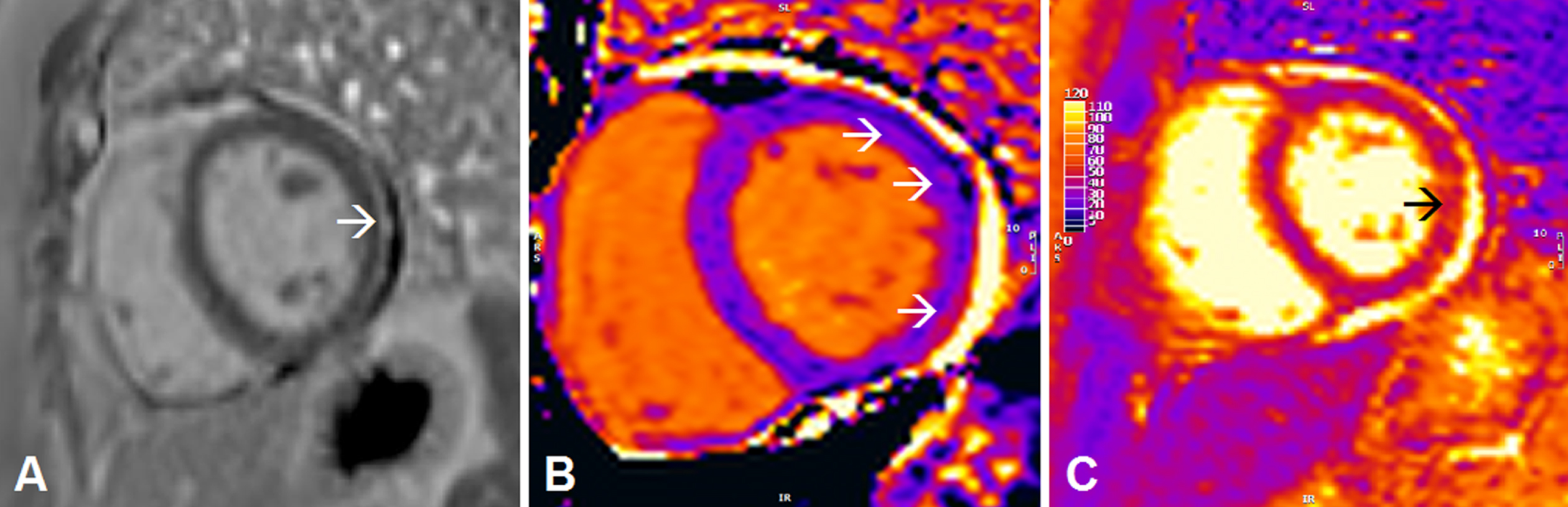 Abnormalities on cardiac magnetic resonance imaging (CMR) in short-axis view consistent with (peri)myocarditis in a patient with non-specific myositis/overlap myositis. Classic CMR (peri)myocarditis abnormalities: late gadolinium enhancement indicating myocardial fibrosis is seen epicardial in the basal-mid inferolateraal segment on T1-weighted imaging. Parametric T1/T2-mapping allows for quantitative (re-)evaluation of (peri)myocarditis abnormalities: increased values on T1-mapping (arrows Fig. 1B) and T2-mapping (arrow Fig. 1C) indicating myocardial oedema are (focally) seen in the inferolateral segment (short axis view).