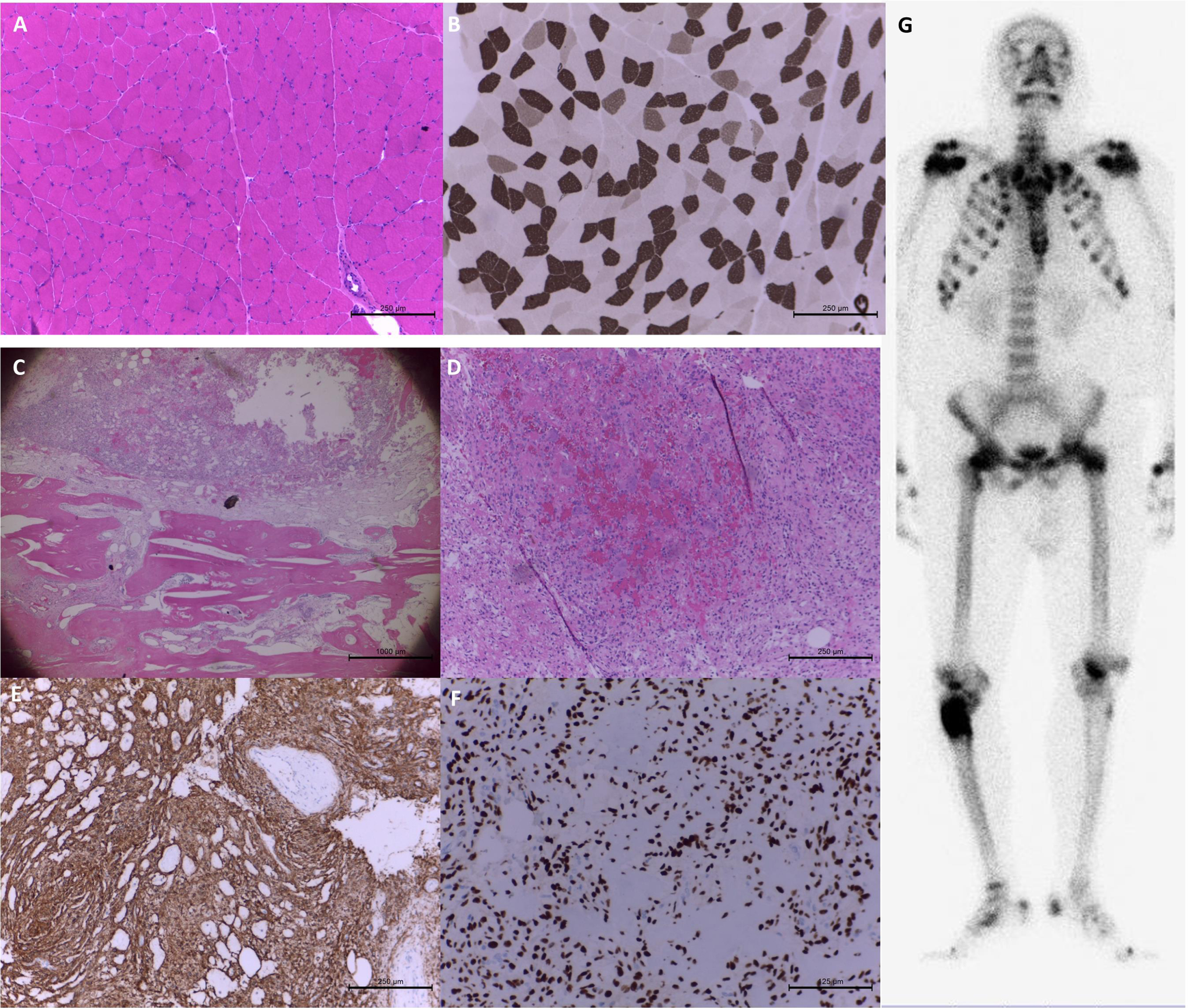 Muscle and bone histopathology in patient 28 with tumor-induced osteomalacia. The staining of hematoxylin and eosin (H&E) (A) and myosin adenosine triphosphatase at pH 4.3 (B) showed compacted muscle fibers with scattered atrophic fibers in the biopsy at left biceps brachii. The bone tumor pathology showed spindle tumor cells in myxohyalinized fibrotic stroma with eosinophilic matrix-like materials accompanying the bony components in H&E staining. (C&D) Focal bony destruction, woven bone formation and grungy calcification were also noted. The immunohistochemical staining of CD56 (E) and SATB2 (F) was strongly positive. Whole-body bone scintigraphy revealed a bone tumor with markedly increased osteoblastic activity at the right proximal femur. (G) Additionally, there were multiple posttraumatic changes in the thoracic cage, pubic bones, and bilateral femurs.