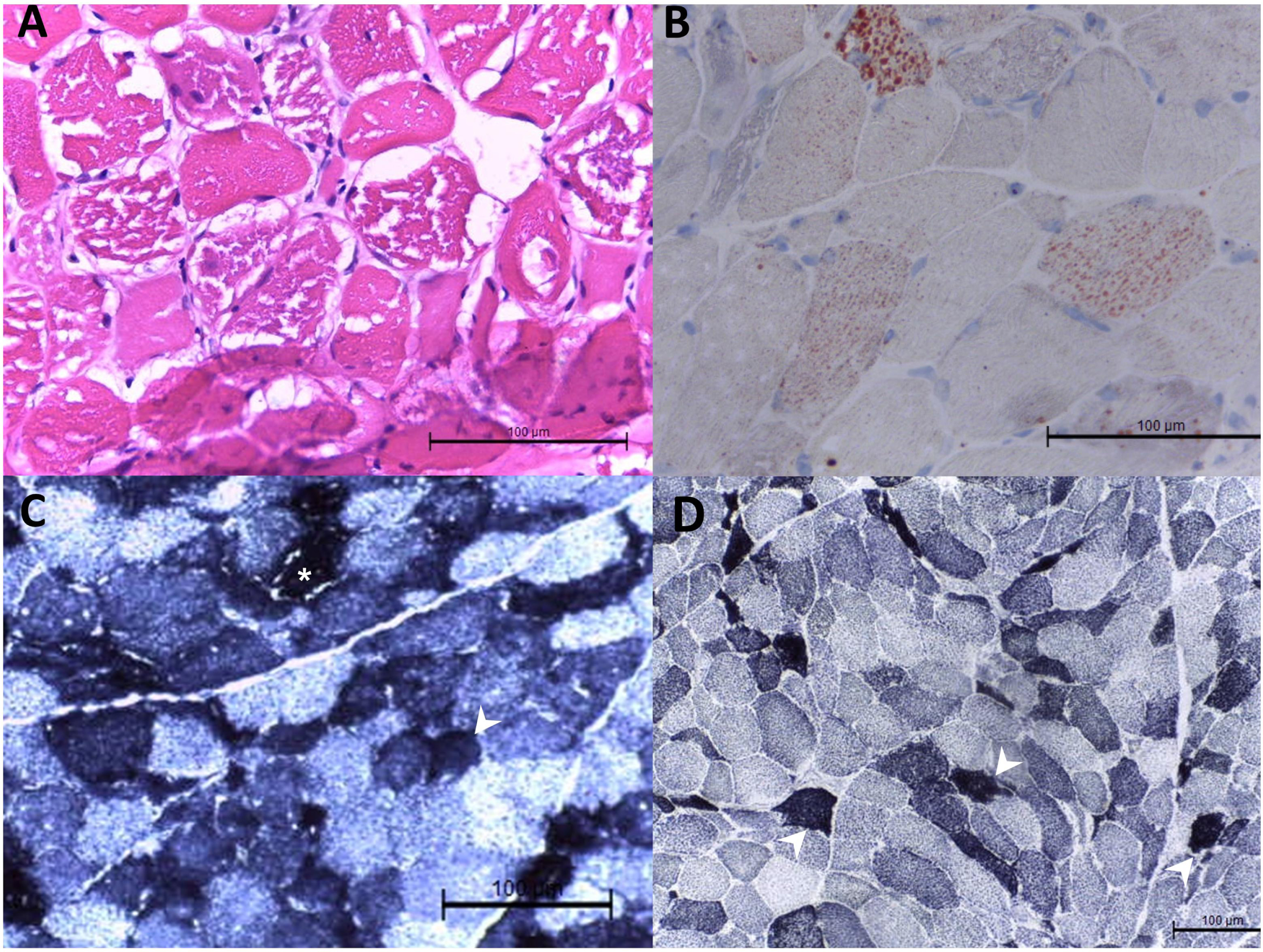Muscle histopathology in patient 29 with mitochondrial myopathy. Hematoxylin and eosin staining showed variated muscle fiber sizes, degenerative and atrophic muscle fiber sizes, and nuclear internalization in the biopsy at the left biceps brachii. There were muscle fibers with variated cytoplasmic vacuoles. The vacuole was strongly positive for Oil Red O staining (B). In the staining of nicotinamide adenine dinucleotide-tetrazolium reductase (NADH-TR) (C) and succinate dehydrogenase (D), dark staining was noted in some muscle fibers (arrowhead). Vacuoles were also seen in the NADH-TR staining ( *).