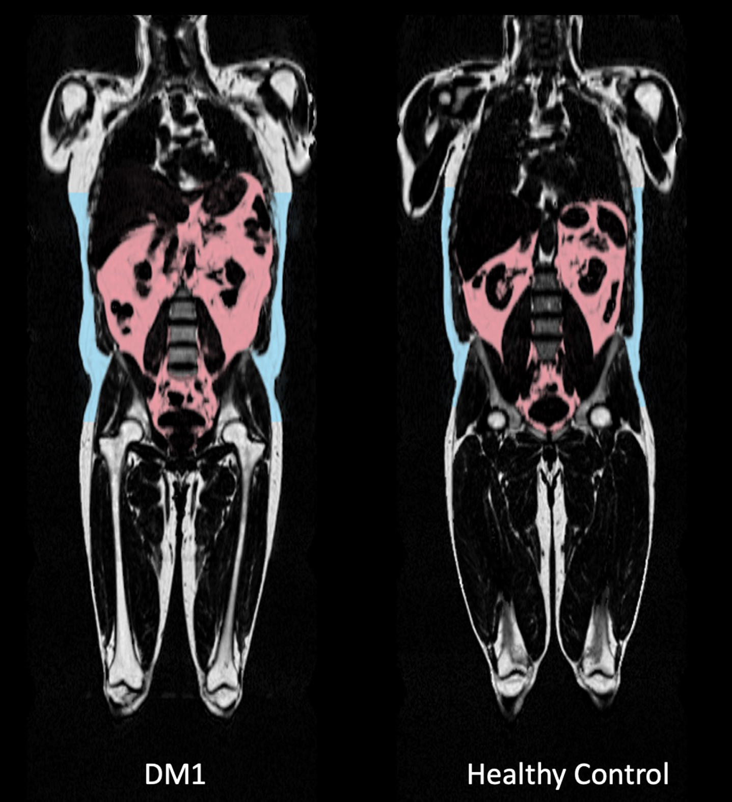 Comparison of full body MRI images between a myotonic dystrophy type 1 (DM1) patient and a healthy age-, sex- and BMI-matched control. Visceral adipose tissue (VAT) deposition is highlighted in pink. VAT volume was 5,59L in the displayed DM1 patient versus 4,28 L in the healthy matched control. Subcutaneous fat deposition is highlighted in blue, as part of the total adipose tissue volume. Also note the difference in shoulder and leg musculature: thigh lean muscle volume was 11,1 L in the DM1 patient versus 15,1 L in the healthy control, as part of total lean tissue volume.