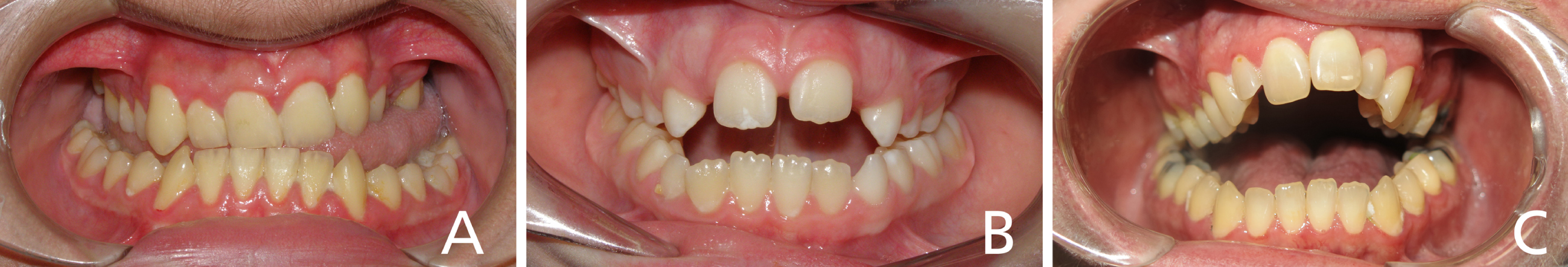 A-C Open bite categories: A) lateral open bite (LOB); B) anterior open bite (AOB); and C) severe anterior open bite (AOBS).