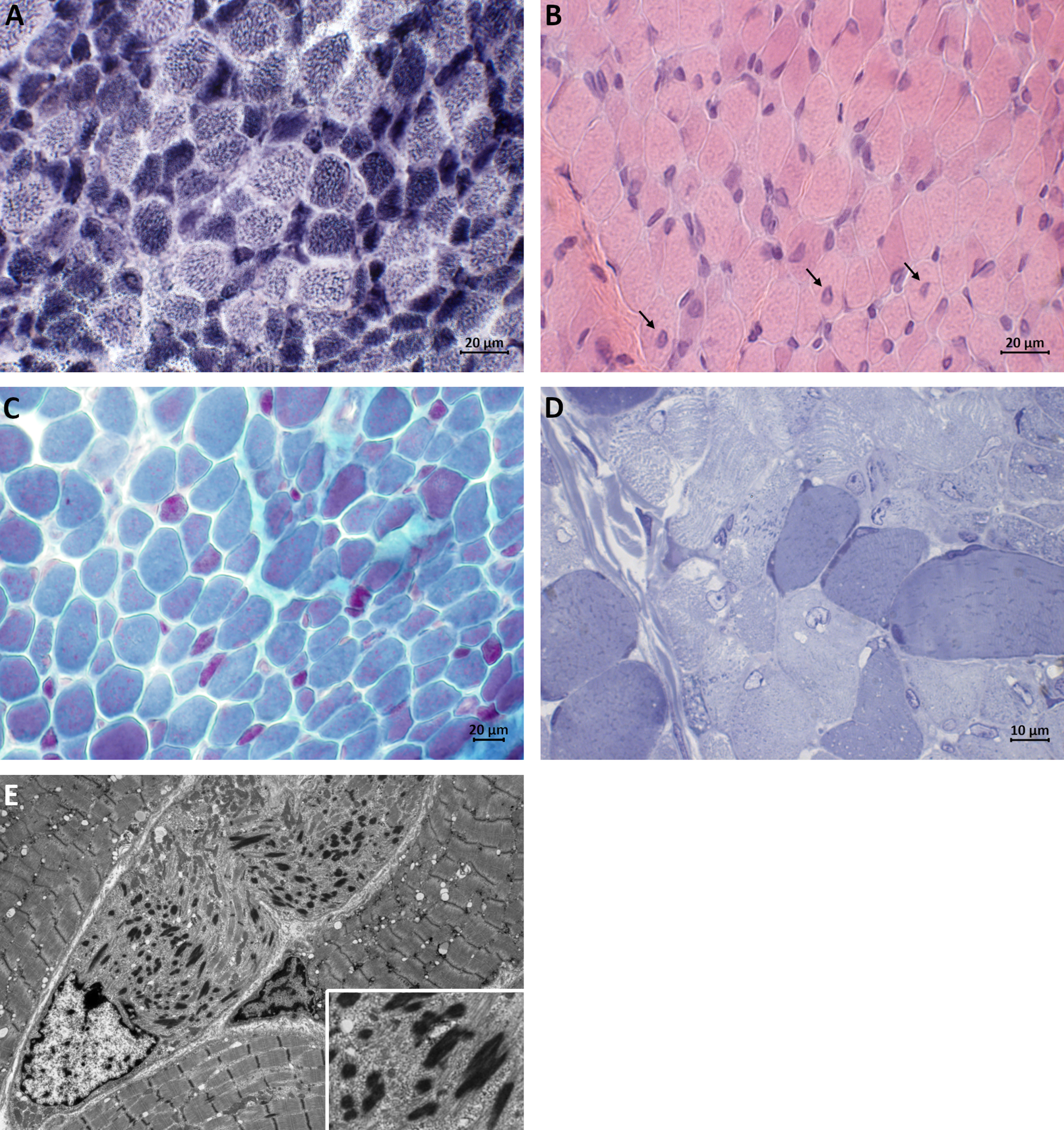 Muscle biopsy taken at the age of 7 months. (A) Darkly stained type 1 fibers are predominantly smaller in size than lightly stained type 2 fibers (NADH-TR staining). (B) H&E staining showing central nuclei in several fibers (arrows). (C) Red nemaline bodies are accumulated in small type 1 fibers and scattered rods are seen in larger fibers (Gomori trichrome staining). (D) Semithin section showing darkly staining rod-like structures (Toluidine blue staining). (E) Electron micrograph showing electron-dense ovoid-shaped nemaline rods.